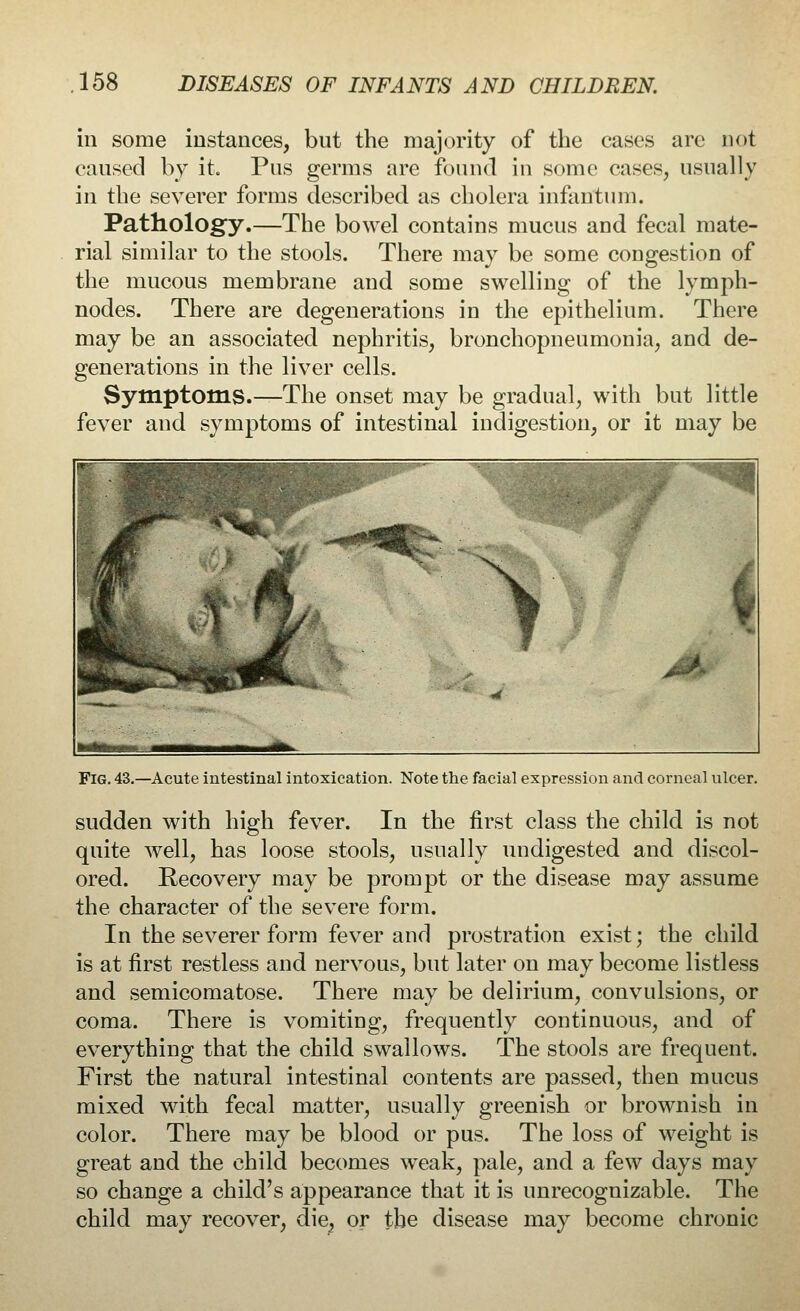 in some instances, but the majority of the cases are not caused by it. Pus germs are found in some cases, usually in the severer forms described as cholera infantum. Pathology.—The bowel contains mucus and fecal mate- rial similar to the stools. There may be some congestion of the mucous membrane and some swelling of the lymph- nodes. There are degenerations in the epithelium. There may be an associated nephritis, bronchopneumonia, and de- generations in the liver cells. Symptoms.—The onset may be gradual, with but little fever and symptoms of intestinal indigestion, or it may be Fig. 43.—Acute intestinal intoxication. Note the facial expression and corneal ulcer. sudden with high fever. In the first class the child is not quite well, has loose stools, usually undigested and discol- ored. Recovery may be prompt or the disease may assume the. character of the severe form. In the severer form fever and prostration exist; the child is at first restless and nervous, but later on may become listless and semicomatose. There may be delirium, convulsions, or coma. There is vomiting, frequently continuous, and of everything that the child swallows. The stools are frequent. First the natural intestinal contents are passed, then mucus mixed with fecal matter, usually greenish or brownish in color. There may be blood or pus. The loss of weight is great and the child becomes weak, pale, and a few days may so change a child's appearance that it is unrecognizable. The child may recover, die, or tbe disease may become chronic