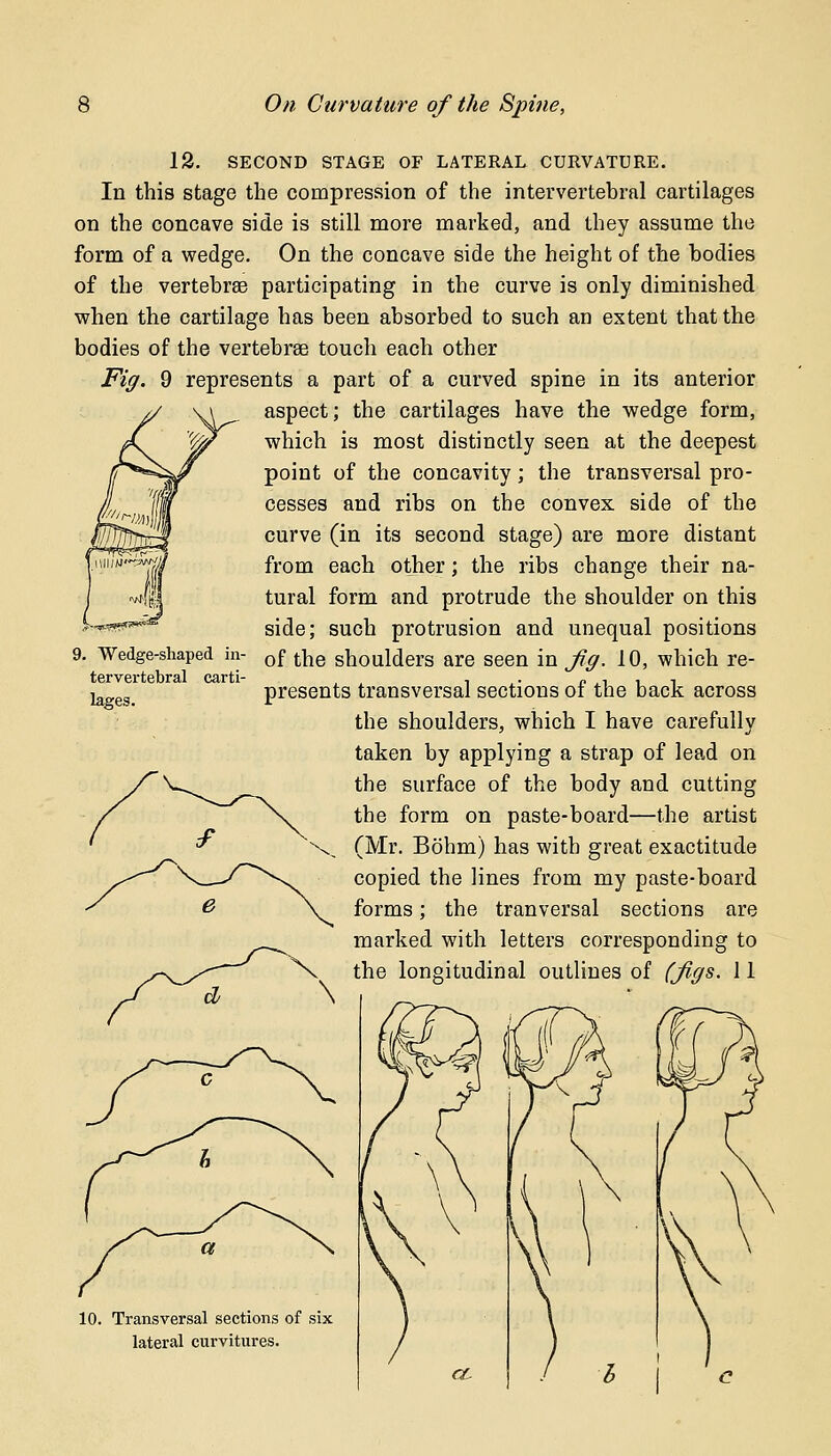 12. SECOND STAGE OF LATERAL CURVATURE. In this stage the compression of the intervertebral cartilages on the concave side is still more marked, and they assume the form of a wedge. On the concave side the height of the bodies of the vertebrae participating in the curve is only diminished when the cartilage has been absorbed to such an extent that the bodies of the vertebrae touch each other Fig. 9 represents a part of a curved spine in its anterior aspect; the cartilages have the wedge form, which is most distinctly seen at the deepest point of the concavity; the transversal pro- cesses and ribs on the convex side of the curve (in its second stage) are more distant from each other; the ribs change their na- tural form and protrude the shoulder on this side; such protrusion and unequal positions of the shoulders are seen in Jig. 10, which re- presents transversal sections of the back across the shoulders, which I have carefully taken by applying a strap of lead on the surface of the body and cutting the form on paste-board—the artist (Mr. Bohm) has with great exactitude copied the lines from my paste-board forms; the tranversal sections are marked with letters corresponding to the longitudinal outlines of (Jigs. 11 9. Wedge-shaped in tervertebral carti lages. 10. Transversal sections of six lateral curvitures.