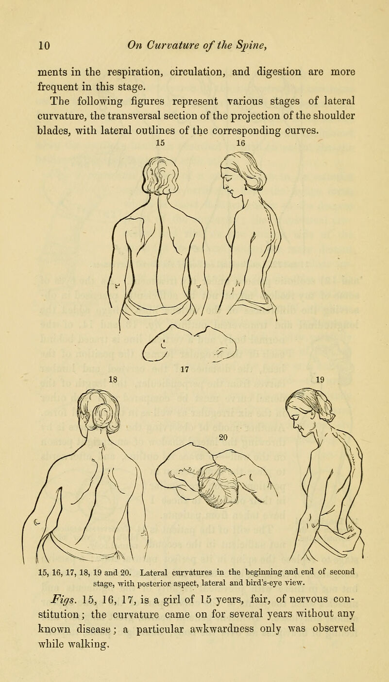 ments in the respiration, circulation, and digestion are more frequent in this stage. The following figures represent various stages of lateral curvature, the transversal section of the projection of the shoulder blades, with lateral outlines of the corresponding curves. 15 16 15, 16, 17, 18, 19 and 20. Lateral curvatures in the beginning and end of second stage, with posterior aspect, lateral and bird's-eye view. Figs. 15, 16, 17, is a girl of 15 years, fair, of nervous con- stitution; the curvature came on for several years without any- known disease; a particular awkwardness only was observed while walking.