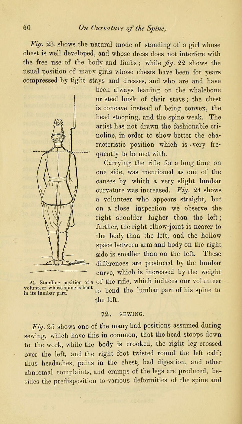 Fig. 23 shows the natural mode of standing of a girl whose chest is well developed, and whose dress does not interfere with the free use of the body and limbs ; while Jig. 22 shows the usual position of many girls whose chests have been for years compressed by tight stays and dresses, and who are and have been always leaning on the whalebone or steel busk of their stays; the chest is concave instead of being convex, the head stooping, and the spine weak. The artist has not drawn the fashionable cri- noline, in order to show better the cha- racteristic position which is -very fre- quently to be met with. Carrying the rifle for a long time on one side, was mentioned as one of the causes by which a very slight lumbar curvature was increased. Fig. 24 shows a volunteer who appears straight, but on a close inspection we observe the right shoulder higher than the left; further, the right elbow-joint is nearer to the body than the left, and the hollow space between arm and body on the right side is smaller than on the left. These differences are produced by the lumbar curve, which is increased by the weight 24. Standing position of a of the rifle, which induces our volunteer rniriuXrilerfneiSbentto bend the lumbar part of his spine to the left. 72. SEWING. Fig. 25 shows one of the many bad positions assumed during sewing, which have this in common, that the head stoops down to the work, while the body is crooked, the right leg crossed over the left, and the right foot twisted round the left calf; thus headaches, pains in the chest, bad digestion, and other abnormal complaints, and cramps of the legs are produced, be- sides the predisposition to various deformities of the spine and