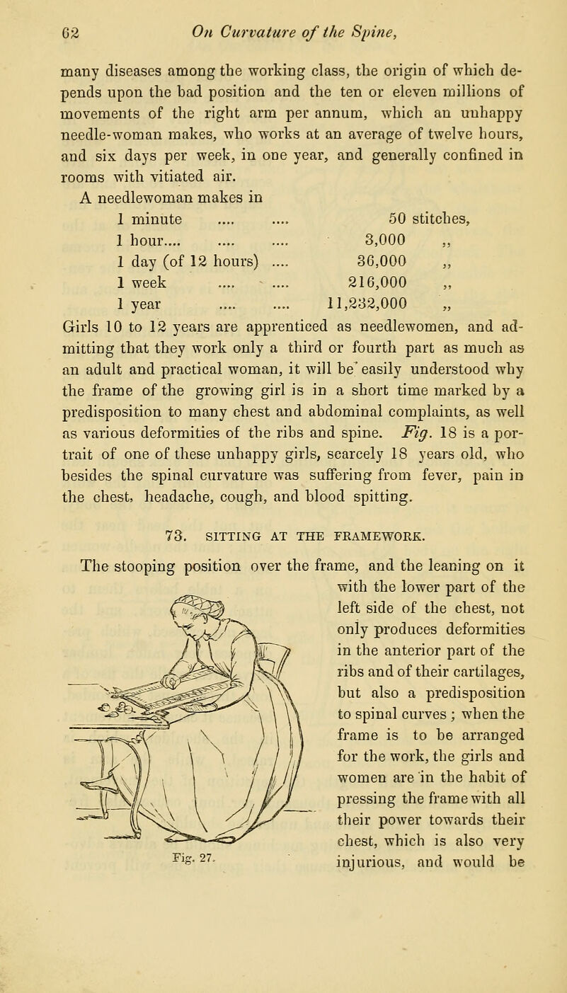 many diseases among the working class, the origin of which de- pends upon the bad position and the ten or eleven millions of movements of the right arm per annum, which an unhappy needle-woman makes, who works at an average of twelve hours, and six days per week, in one year, and generally confined in rooms with vitiated air. A needlewoman makes in 1 minute 1 hour.... 1 day (of 12 hours) 1 week 1 year 50 stitches, 3,000 30,000 210,000 11,232,000 Girls 10 to 12 years are apprenticed as needlewomen, and ad- mitting that they work only a third or fourth part as much as an adult and practical woman, it will be easily understood why the frame of the growing girl is in a short time marked by a predisposition to many chest and abdominal complaints, as well as various deformities of the ribs and spine. Fig. 18 is a por- trait of one of these unhappy girls, scarcely 18 years old, who besides the spinal curvature was suffering from fever, pain in the chest, headache, cough, and blood spitting. 73. SITTING AT THE FRAMEWORK. The stooping position over the frame, and the leaning on it with the lower part of the left side of the chest, not only produces deformities in the anterior part of the ribs and of their cartilages, but also a predisposition to spinal curves ; when the frame is to be arranged for the work, the girls and women are in the habit of pressing the frame with all their power towards their chest, which is also very injurious, and would be Fkr. 27.