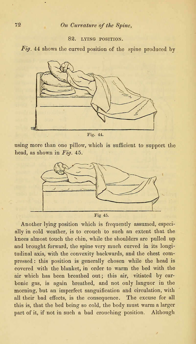 82. LYING POSITION. Fig. 44 shows the curved position of the spine produced by Fig. 44. using more than one pillow, which is sufficient to support the head, as shown in Fig. 45. Fig 45. Another lying position which is frequently assumed, especi- ally in cold weather, is to crouch to such an extent that the knees almost touch the chin, while the shoulders are pulled up and brought forward, the spine very much curved in its longi- tudinal axis, with the convexity backwards, and the chest com- pressed : this position is generally chosen while the head is covered with the blanket, in order to warm the bed with the air which has been breathed out; this air, vitiated by car- bonic gas, is again breathed, and not only languor in the morning, but an imperfect sanguification and circulation, with all their bad effects, is the consequence. The excuse for all this is, that the bed being so cold, the body must warm a larger part of it, if not in such a bad crouching position. Although