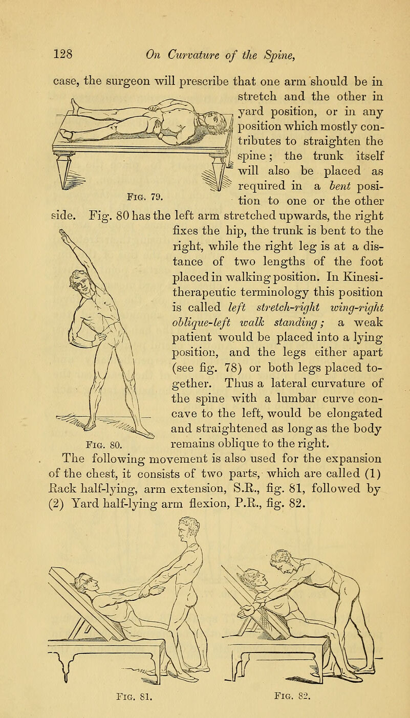 side. case, the surgeon will prescribe that one arm should be in stretch and the other in yard position, or in any position which mostly con- tributes to straighten the spine; the trunk itself will also be placed as required in a bent posi- tion to one or the other Fig. 80 has the left arm stretched upwards, the right fixes the hip, the trunk is bent to the right, while the right leg is at a dis- tance of two lengths of the foot placed in walking position. In Kinesi- therapeutic terminology this position is called left stretch-right wing-right oblique-Left walk standing; a weak patient would be placed into a lying position, and the legs either apart (see fig. 78) or both legs placed to- gether. Thus a lateral curvature of the spine with a lumbar curve con- cave to the left, would be elongated and straightened as long as the body Fig. 80. remains oblique to the right. The following movement is also used for the expansion of the chest, it consists of two parts, which are called (1) Rack half-lying, arm extension, S.R., fig. 81, followed by (2) Yard half-lying arm flexion, P.R., fig. 82.