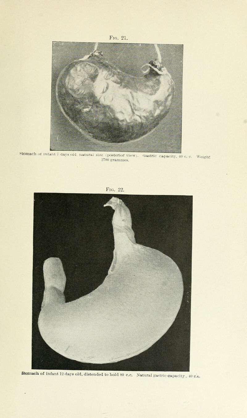 Frr,. 2i. Stomach of infant 7 davs nl.i iiatur '>-iirh.r . lew). Gastric capacity, 40 c. c. Weight .1,'raiunies. Fig. 22. Stomach of infant 12 days old, distended to hold SO c.c. Natural gastric capacity, 40 e.t.