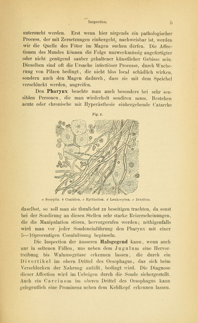 untersucht werden. Erst wenn hier nirgends ein pathologischer Process, der mit Zersetzungen einhergeht, nachweisbar ist, werden wir die Quelle des Fötor im Magen suchen dürfen. Die Atfec- tionen des Mundes können die Folge unzweckmässig angefertigter oder nicht genügend sauber gehaltener künstlicher Gebisse sein. Dieselben sind oft die Ursache infectiöser Processe, durch Wuche- rung von Pilzen bedingt, die nicht blos local schädlich wirken, sondern auch den Magen dadurch, dass sie mit dem Speichel verschluckt werden, angreifen. Den Pharyox beachte man auch besonders bei sehr sen- siblen Personen, die man wiederholt sondiren muss. Bestehen acute oder chronische mit Hyperästhesie einhergehende Catarrhe Fig. 2. a Soorpilz. b Conidien. c Epithelien. d Leukocyten. e Detritus. daselbst, so soll man sie thunlichst zu beseitigen trachten, da sonst bei der Sondirung an diesen Stellen sehr starke Reizerscheinungen, die die Manipulation stören, hervorgerufen werden; nöthigenfalls wird man vor jeder Sondeneinführung den Pharynx mit einer 5—lOprocentigen Cocai'nlösung bepinseln. Die Inspection der äusseren Halsgegend kann, wenn auch nur in seltenen Fällen, uns neben dem Jugulum eine Hervor- treibung bis Walnns?grösse erkennen lassen, die durch ein Divertikel im obern Drittel des Oesophagus, das sich beim Verschlucken der Nahrung anfüllt, bedingt v/ird. Die Diagnose dieser Afif'ection wird im Uebrigen durch die Sonde sichergestellt. Auch ein C a r c i n 0 ni im oberen Drittel des Oesophagus kann gelegentlich eine Prominenz neben dem Kehlkopf erkennen lassen.