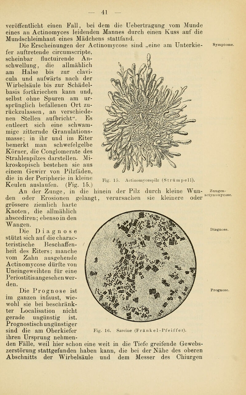 Fig. 15. Actiuoniycesiiilz (Strümpell). veröffentlicht einen Fall, bei dem die Uebertragung vom Munde eines an Actinomyces leidenden Mannes durch einen Kuss auf die Mundschleimhaut eines Mädchens stattfand. Die Erscheinungen der Actinomycose sind „eine am Unterkie- Symptome. fer auftretende circumscripte, scheinbar iiuctuirende An- schwellung, die allmählich am Halse bis zur clavi- cula und aufwärts nach der Wirbelsäule bis zur Schädel- basis fortkriechen kann und, selbst ohne Spuren am ur- sprünglich befallenen Ort zu- rückzulassen , an verschiede- nen Stellen aufbricht-'. Es entleert sich eine schwam- mige zitternde Granulations- masse; in ihr und im Eiter bemerkt man schwefelgelbe Körner, die Conglomerate des Strahlenpilzes darstellen. Mi- kroskopisch bestehen sie aus einem Gewirr von Pilzfäden, die in der Peripherie in kleine Keulen auslaufen. (Fig. 15.) An der Zunge, in die hinein der Pilz durch kleine Wun- zuugen- den oder Erosionen gelangt, verursachen sie kleinere oder ^° y'^^'^^'^^^- grössere ziemlich harte Knoten, die allmählich abscediren; ebenso in den Wangen. Die Diagnose ^ ''^'.r^i4''t^\.^ßK^.. \ Diagnose. stützt sich auf die charac- teristische Beschaffen- heit des Eiters; manche vom Zahn ausgehende Actinomycose dürfte von Uneingeweihten für eine Periostitis angesehen wer- den. Die Prognose ist V .*^i-^A.li'^'Sä?r^V tsr- ^^jf Prognose. im ganzen infaust, wie- wohl sie bei beschränk- ter Localisation nicht gerade ungünstig ist. Prognostisch ungünstiger sind die am Oberkiefer ihren Ursprung nehmen- den Fälle, weil hier schon eine weit in die Tiefe greifende Gewebs- zerstörung stattgefunden haben kann, die bei der Nähe des oberen Abschnitts der Wirbelsäule und dem Messer des Chiurgen Fig. 16. Sarcine (Frank e 1-Pfe if fer).