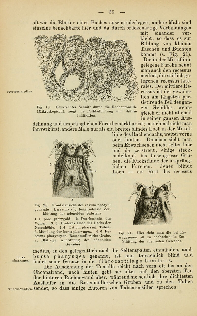 recessus medius. oft wie die Blätter eines Buches auseinanderlegen; andere Male sind einzelne benachbarte hier und da durch brückenartige Verbindungen mit einander ver- klebt, so dass es zur Bildung von kleinen Taschen und Buchten kommt (s. Fig. 21). Die in der Mittellinie elegene Furche nennt man auch den recessus edius, die seitlich ge- egenen recessuslate- ^ ^ ^ ^^ ^ ^ rales. Der mittlere Re- ^^^^M^^^^^^M^^^. :\i0^? cessus ist der gewöhn- '^^Ml§5^^^?^^-^^^!^'i^^S^c lieh am längsten per- - ■■.■^.■.y-,:y-::-:.-:.':,:'.--'..-^.-;.<'-^-^uv::-::-:-^---^-- sistlrcudeTeildesgau- 19. Senkrechter Schnitt durch die Rachentonsille (Mikroskopisch), zeigt die Follikelbildung und diffuse Infiltration. Fig zen Gebildes, wenn- gleich er nicht allemal in seiner ganzen Aus- dehnung und ursprünglichen Form bemerkbar ist; manchmal sieht man ihn verkürzt, andere Male nur als ein breites blindes Loch in der Mittel- linie des Rachendachs, weiter vorne oder hinten. Daneben sieht man beim Erwachsenen nicht selten hier und da zerstreut, einige Steck- nadelkopf- bis linsengrosse Gru- ben, die Rückstände der ursprüng- lichen Furchen. Jenes blinde Loch — ein Rest des recessus Fig. 21. Hier wachsenen oft sieht mau die bei Er- zu beobachtende Zer- klüftung des adenoiden Gewebes Mg. 20. Frontalansicht des cavum pharyn- gonasale (Luschka), longitudinale Zer- klüftung der adenoiden Substanz. l.l. proc. pterygoid. 2. Durchschnitt des Vomer. 3. 3. Hinteres Ende des Dachs der Nasenhöhle. 4.4. Ostium pharvng. Tubae. 5. Mündung der bursa pharvngea. 6. 6. Ee- cessus phar^Tigeus, RosenmüUersche Grube. 7. Blättrige Anordnung des adenoiden Gewebes. medius, in den gelegentlich auch die Seitenspalten einmünden, auch bursa pharyngea genannt, ist nun tatsächlich blind und findet seine Grenze in der f ibrocartilag o basilaris. Die Ausdehnung der Tonsille reicht nach vorn oft bis an den Choanalrand, nach hinten geht sie öfter auf den obersten Teil der hinteren Rachenwand über, während sie seitlich ihre dichtesten Ausläufer in die Rosenmüllerschen Gruben und zu den Tuben Tubentonsiuen. sendet, SO dass einige Autoren von Tubentonsillen sprechen. bursa pbaryngea.