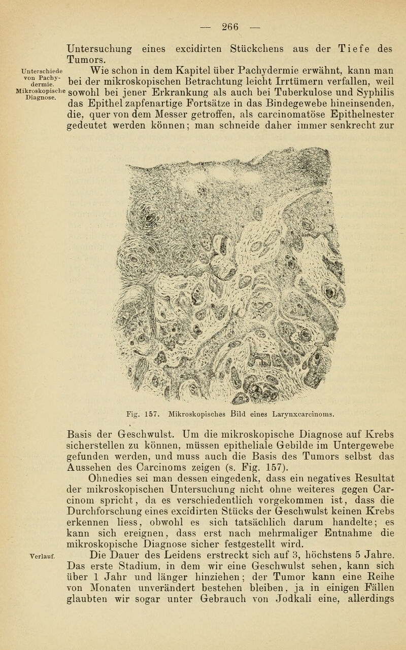Untersuchung eines excidirten Stückcliens aus der Tiefe des Tumors. Unterschiede Wie schou in dem Kapitel über Pachydermie erwähnt, kann man ^°de^mie.* bei der mikroskopischen Betrachtung leicht Irrtümern verfallen, weil Mikroskopisciie gQy^ohl bei icner Erkrankung als auch bei Tuberkulose und Syphilis das Epithel zapfenartige Portsätze in das Bindegewebe hineinsenden, die, quer von dem Messer getroffen, als carcinomatöse Epithelnester gedeutet werden können; man schneide daher immer senkrecht zur Diagnose. .W.S*4#,^ • ■M »- ^. '4 *5^- Fig. 157. Mikroskopisches Bild eines Laiynxcarcinoras. Verlauf. Basis der Geschwulst. Um die mikroskopische Diagnose auf Krebs sicherstellen zu können, müssen epitheliale Gebilde im Untergewebe gefunden werden, und muss auch die Basis des Tumors selbst das Aussehen des Carcinoms zeigen (s. Fig. 157). Ohnedies sei man dessen eingedenk, dass ein negatives Resultat der mikroskopischen Untersuchung nicht ohne weiteres gegen Car- cinom spricht, da es verschiedentlich vorgekommen ist, dass die Durchforschung eines excidirten Stücks der Geschwulst keinen Krebs erkennen Hess, obwohl es sich tatsächlich darum handelte; es kann sich ereignen, dass erst nach mehrmaliger Entnahme die mikroskopische Diagnose sicher festgestellt wird. Die Dauer des Leidens erstreckt sich auf 3, höchstens 5 Jahre. Das erste Stadium, in dem wir eine Geschwulst sehen, kann sich über 1 Jahr und länger hinziehen; der Tumor kann eine Reihe von Monaten unverändert bestehen bleiben, ja in einigen Fällen glaubten wir sogar unter Gebrauch von Jodkali eine, allerdings