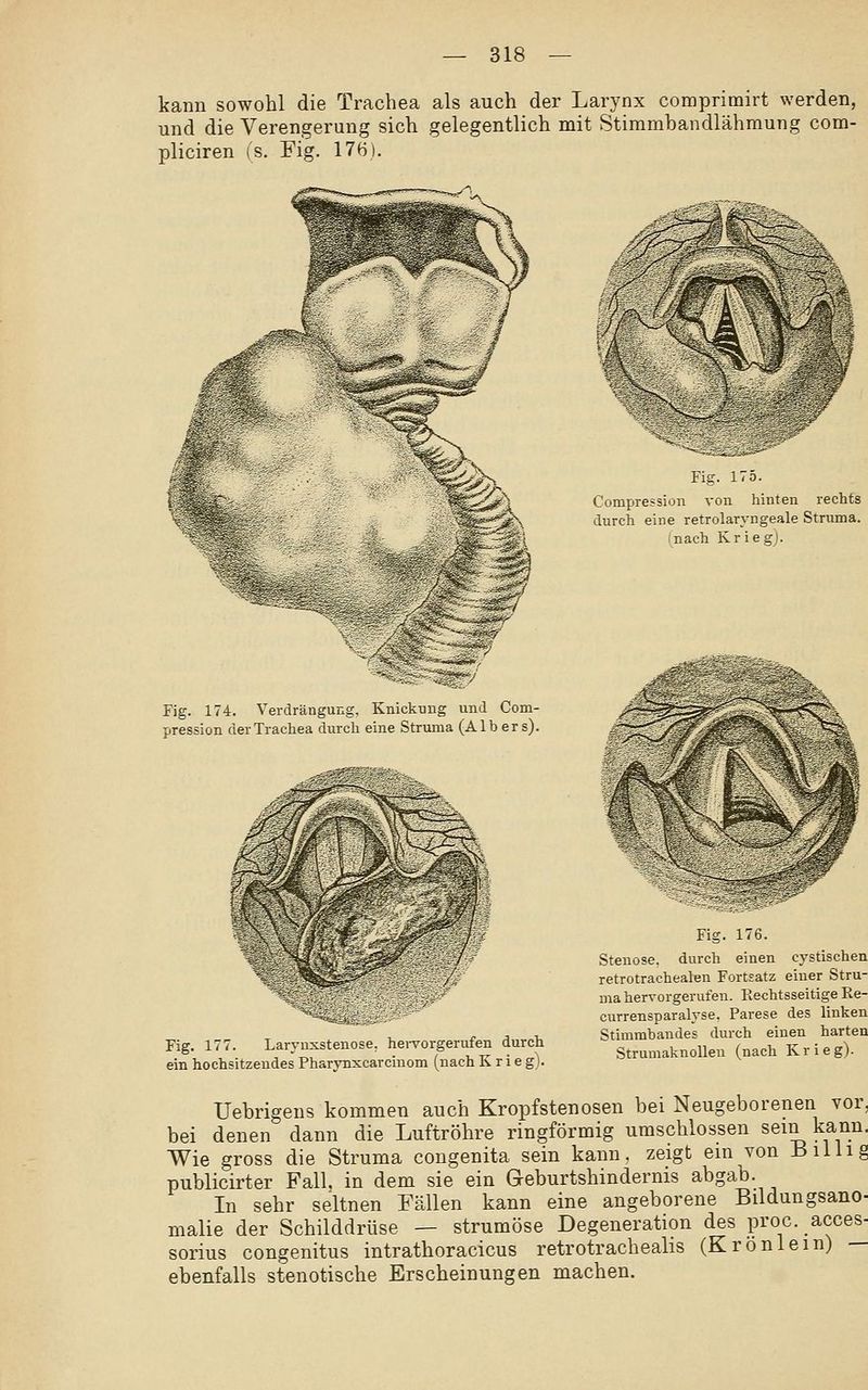 kann sowohl die Trachea als auch der Larynx comprimirt werden, und die Verengerung sich gelegentlich mit Stimmbandlähmung com- pliciren (s. Fig. 17H), Fig. 174. Verdrängung, Knickung und Com- pression der Trachea durch eine Struma (Alb er s). Fig. 177. Laryuxstenose. hervorgerufen durch ein hochsitzeudes Pharynxcarcinom (nach K r i e g). Fig. 175. Compression von hinten rechts durcii eine retrolaryngeale Struma. (nach Kr ieg). j^ Fig. 176. Stenose, durch einen eystischen retrotrachealen Fortsatz einer Stru- ma hervorgerufen. Rechtsseitige Re- currensparalyse. Parese des linken Stimmbandes durch einen harten StrumaknoUeu (nach Krieg). Uebrigens kommen auch Kropfstenosen hei Neugeborenen vor, bei denen dann die Luftröhre ringförmig umschlossen sein kann. Wie gross die Struma congenita sein kann, zeigt em von Billig publicirter Fall, in dem sie ein Geburtshindernis abgab. In sehr seltnen Fällen kann eine angeborene Bildungsano- malie der Schilddrüse — strumöse Degeneration des proc.acces- sorius congenitus intrathoracicus retrotracheahs (Krönlem) — ebenfalls stenotische Erscheinungen machen.