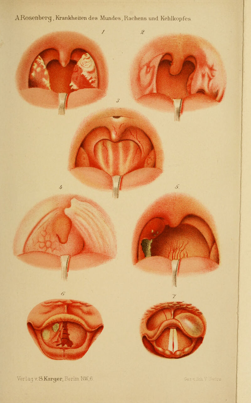 A.Rosenberg, Krankheiten des Mundes J-lachens und Kohlkopfes 6- Verlag v.S.Karger, Berlin NW,6.