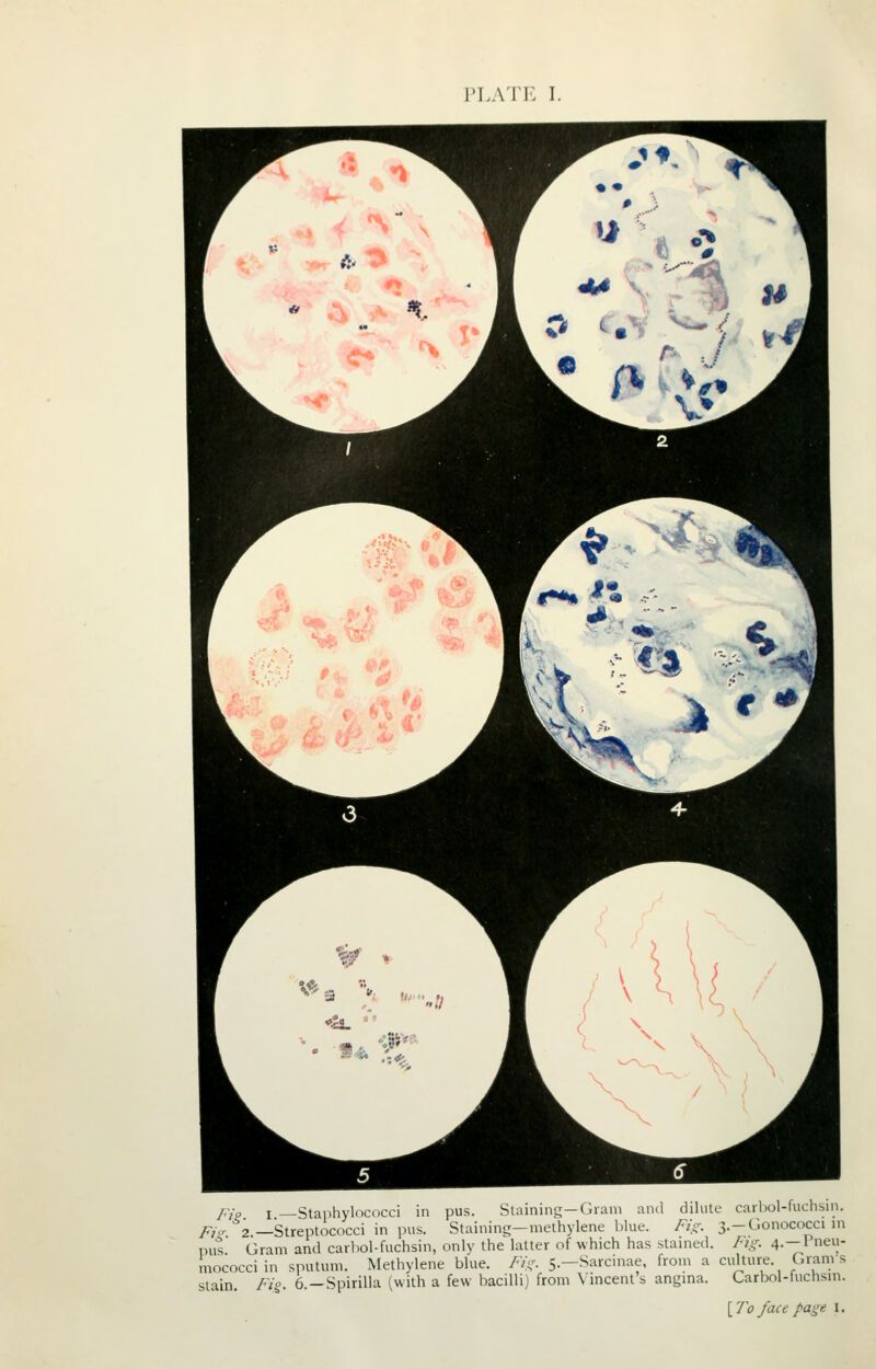 ri.ATE I. fjo I —Staphylococci in pus. Slaininij—Gram and dilute carbol-fuchsm. Fi^ 2 —Streptococci in pus. Staining-methylene blue. Fis;. 3.-Gonococci in pus Gram and carhol-fuchsin, only the latter of which has stained. Fig. 4.—Pneu- mococciin sputum. Methylene blue. Fig. 5.—Sarcinae. from a culture. Grams stain. Fig. 6. —Spirilla (with a few bacilli) from \incent s angina. Carbol-fuchsin. [To face page I.