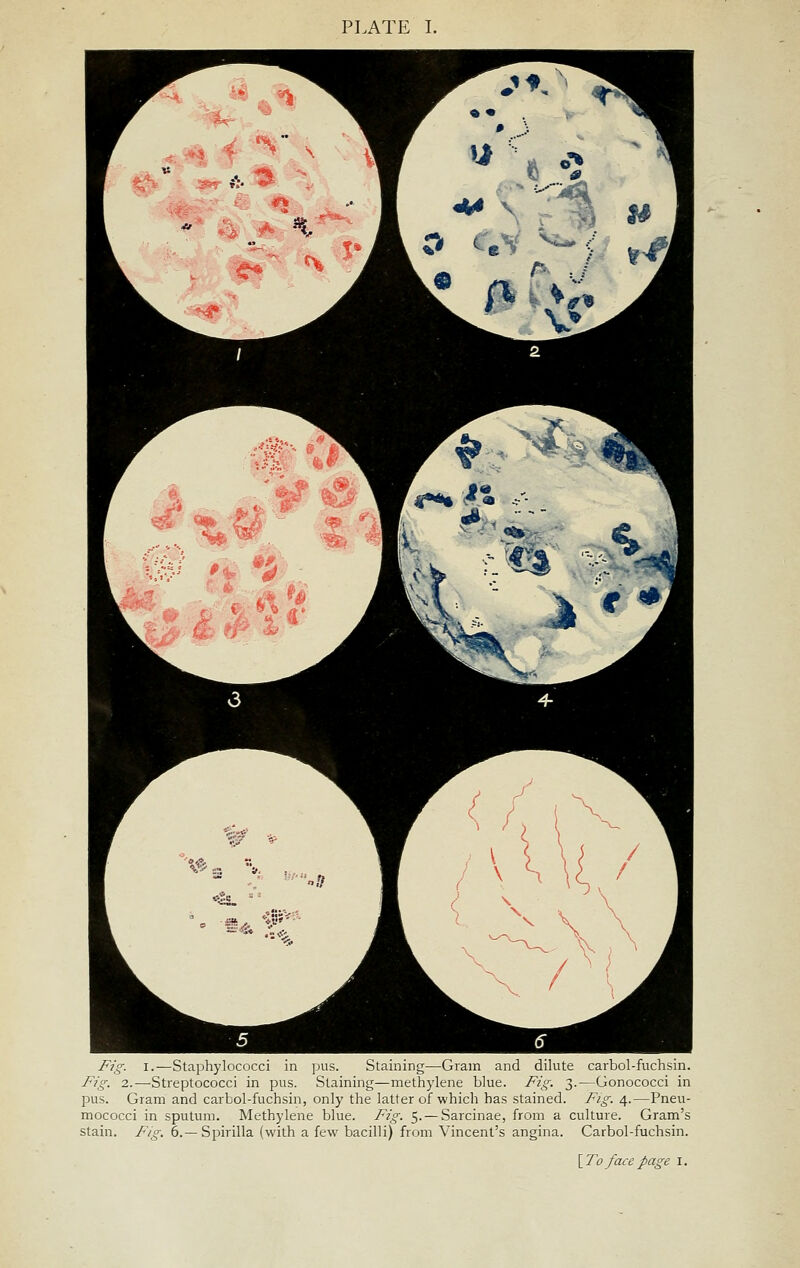 PLATE I. Fig. I.—Staphylococci in pus. Staining—Gram and dilute carbol-fuchsin. Fig. 2.—Streptococci in pus. Staining—methylene blue. Fig. 3.—Gonococci in pus. Gram and carbol-fuchsin, only the latter of which has stained. Fig. 4.—Pneu- mococci in sputum. Methylene blue. Fig. 5. — Sarcinae, from a culture. Gram's stain. Fig. 6.—Spirilla (with a few bacilli) from Vincent's angina. Carbol-fuchsin. \To face page i.