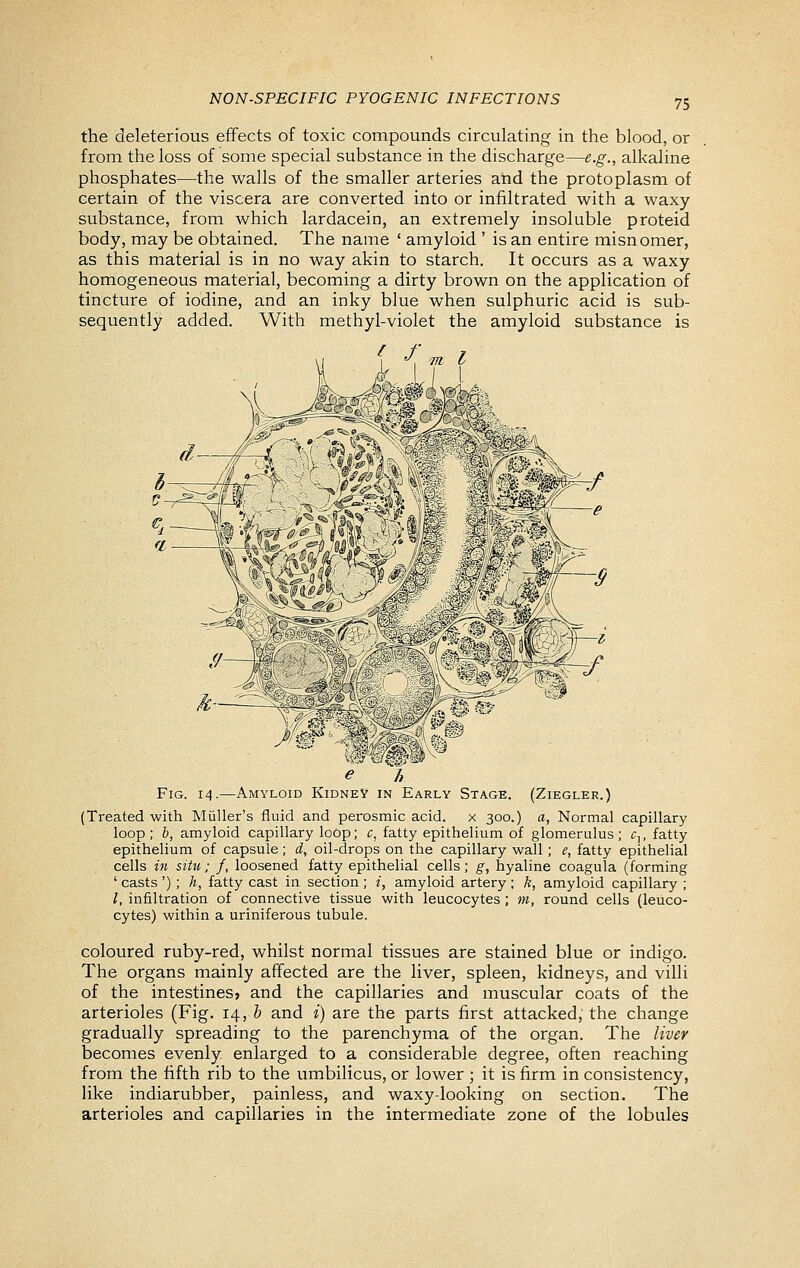 the deleterious effects of toxic compounds circulating in the blood, or from the loss of some special substance in the discharge—e.g., alkaline phosphates—the walls of the smaller arteries and the protoplasm of certain of the viscera are converted into or infiltrated with a waxy substance, from which lardacein, an extremely insoluble proteid body, may be obtained. The name ' amyloid ' is an entire misnomer, as this material is in no way akin to starch. It occurs as a waxy homogeneous material, becoming a dirty brown on the application of tincture of iodine, and an inky blue when sulphuric acid is sub- sequently added. With methyl-violet the amyloid substance is )^f%m^p (ZlEGLER.) a, Normal capillary e h Fig. 14.—Amyloid KidneV in Early Stage. (Treated with Miiller's fluid and perosmic aeid. x 300.) loop ; h, amyloid capillary loop; c, fatty epithelium of glomerulus ; c\, fatty epithelium of capsule; A, oil-drops on the capillary wall; e, fatty epithelial cells in situ; /, loosened fatty epithelial cells; g, hyaline coagula (forming ' casts '); h, fatty cast in section ; i, amyloid artery ; k, amyloid capillary ; I, infiltration of connective tissue with leucocytes ; m, round cells (leuco- cytes) within a uriniferous tubule. coloured ruby-red, whilst normal tissues are stained blue or indigo. The organs mainly affected are the liver, spleen, kidneys, and villi of the intestines, and the capillaries and muscular coats of the arterioles (Fig. 14, h and i) are the parts first attacked, the change gradually spreading to the parenchyma of the organ. The liver becomes evenly enlarged to a considerable degree, often reaching from the fifth rib to the umbilicus, or lower ; it is firm in consistency, like indiarubber, painless, and waxy-looking on section. The arterioles and capillaries in the intermediate zone of the lobules