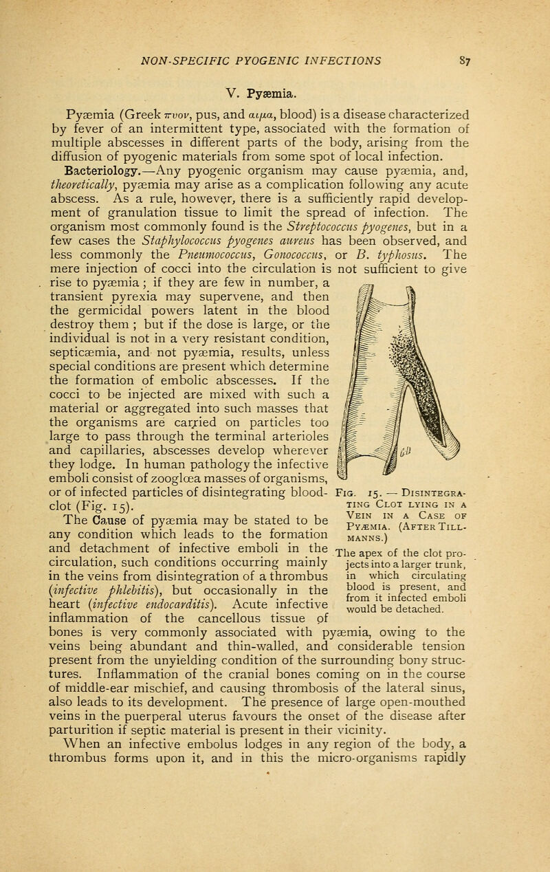 V. Pyaemia. Pyaemia (Greek ttvov, pus, and aifia, blood) is a disease characterized by fever of an intermittent type, associated with the formation of multiple abscesses in different parts of the body, arising from the diffusion of pyogenic materials from some spot of local infection. Bacteriology.—Any pyogenic organism may cause pyaemia, and, theoretically, pyaemia may arise as a complication following any acute abscess. As a rule, however, there is a sufficiently rapid develop- ment of granulation tissue to limit the spread of infection. The organism most commonly found is the Streptococcus pyogenes, but in a few cases the Staphylococcus pyogenes aureus has been observed, and less commonly the Pnemnococcus, Gonococcus, or B. typhosus. The mere injection of cocci into the circulation is not sufficient to give rise to pyaemia; if they are few in number, a transient pyrexia may supervene, and then the germicidal powers latent in the blood destroy them ; but if the dose is large, or the individual is not in a very resistant condition, septicaemia, and not pyaemia, results, unless special conditions are present which determine the formation of embolic abscesses. If the cocci to be injected are mixed with such a material or aggregated into such masses that the organisms are car/ied on particles too large to pass through the terminal arterioles and capillaries, abscesses develop wherever they lodge. In human pathology the infective li emboli consist of zooglcea masses of organisms, ^ or of infected particles of disintegrating blood- Fig. clot (Fig. 15). The Ca.use of pyaemia may be stated to be any condition which leads to the formation and detachment of infective emboli in the jj^g ^p^^'^f the clot pro- circulation, such conditions occurring mainly jects into a larger trunk, in the veins from disintegration of a thrombus (infective phlebitis), but occasionally in the heart (infective endocarditis). Acute infective inflammation of the cancellous tissue of bones is very commonly associated with pyaemia, owing to the veins being abundant and thin-walled, and considerable tension present from the unyielding condition of the surrounding bony struc- tures. Inflammation of the cranial bones coming on in the course of middle-ear mischief, and causing thrombosis of the lateral sinus, also leads to its development. The presence of large open-mouthed veins in the puerperal uterus favours the onset of the disease after parturition if septic material is present in their vicinity. When an infective embolus lodges in any region of the body, a thrombus forms upon it, and in this the micro-organisms rapidly 15. — Disintegra- ting Clot lying in a Vein in a Case of Pyemia. (After Till- MANNS.) which circulating blood is present, and from it infected emboli would be detached.