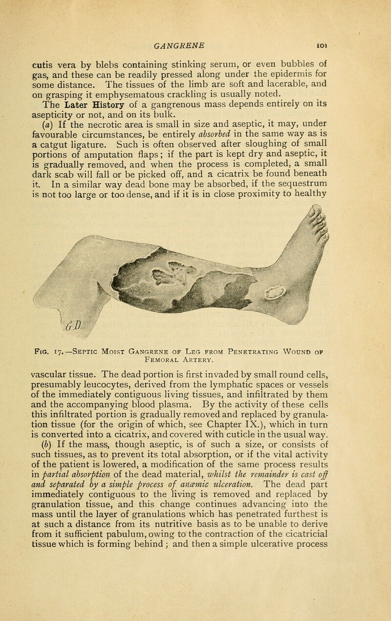 cutis vera by blebs containing stinking serum, or even bubbles of gas, and these can be readily pressed along under the epidermis for some distance. The tissues of the limb are soft and lacerable, and on grasping it emphysematous crackling is usually noted. The Later History of a gangrenous mass depends entirely on its asepticity or not, and on its bulk. (a) If the necrotic area is small in size and aseptic, it may, under favourable circumstances, be entirely absorbed in the same way as is a catgut ligature. Such is often observed after sloughing of small portions of amputation flaps; if the part is kept dry and aseptic, it is gradually removed, and when the process is completed, a small dark scab will fall or be picked off, and a cicatrix be found beneath it. In a similar way dead bone may be absorbed, if the sequestrum is not too large or too dense, and if it is in close proximity to healthy / /■ ^M FiG. 17.—Septic Moist Gangrene of Leg from Penetrating Wound of Femoral Artery. vascular tissue. The dead portion is first invaded by small round cells, presumably leucocytes, derived from the lymphatic spaces or vessels of the immediately contiguous living tissues, and infiltrated by them and the accompanying blood plasma. By the activity of these cells this infiltrated portion is gradually removed and replaced by granula- tion tissue (for the origin of which, see Chapter IX.), which in turn is converted into a cicatrix, and covered with cuticle in the usual way. (b) If the mass, though aseptic, is of such a size, or consists of such tissues, as to prevent its total absorption, or if the vital activity of the patient is lowered, a modification of the same process results in partial absorption of the dead material, whilst the remainder is cast off and separated by a simple process of ancsmic ulceration. The dead part immediately contiguous to the living is removed and replaced by granulation tissue, and this change continues advancing into the mass until the layer of granulations which has penetrated furthest is at such a distance from its nutritive basis as to be unable to derive from it sufificient pabulum, owing to the contraction of the cicatricial tissue which is forming behind ; and then a simple ulcerative process