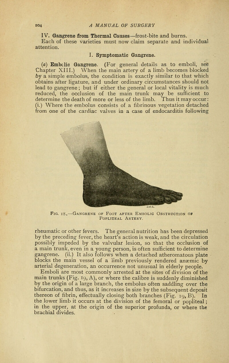 IV. Gangrene from Thermal Causes—frost-bite and burns. Each of these varieties must now claim separate and individual attention. I. Symptomatic G-angrene. (a) Embclic Gangrene. (For general details as to emboli, see Chapter XIII.) When the main artery of a limb becomes blocked 6y a simple embolus, the condition is exactly similar to that which obtains after ligature, and under ordinary circumstances should not lead to gangrene; but if either the general or local vitality is much reduced, the occlusion of the main trunk may be sufficient to determine the death of more or less of the limb. Thus it may occur: (i.) Where the embolus consists of a fibrinous vegetation detached from one of the cardiac valves in a case of endocarditis following Fig. i8,—Gangrene of Foot after Embolic Obstruction of Popliteal Artery. rheumatic or other fevers. The general nutrition has been depressed by the preceding fever, the heart's action is weak, and the circulation possibly impeded by the valvular lesion, so that the occlusion of a main trunk, even in a young person, is often sufficient to determine gangrene, (ii.) It also follows when a detached atheromatous plate blocks the main vessel of a limb previously rendered anaemic by arterial degeneration, an occurrence not unusual in elderly people. Emboli are most commonly arrested at the sites of division of the main trunks (Fig. 19, A), or where the calibre is suddenly diminished by the origin of a large branch, the embolus often saddling over the bifurcation, and thus, as it increases in size by the subsequent deposit thereon of fibrin, efifectually closing both branches (Fig. 19, B). In the lower limb it occurs at the division of the femoral or popliteal; in the upper, at the origin of the superior profunda, or where the brachial divides.