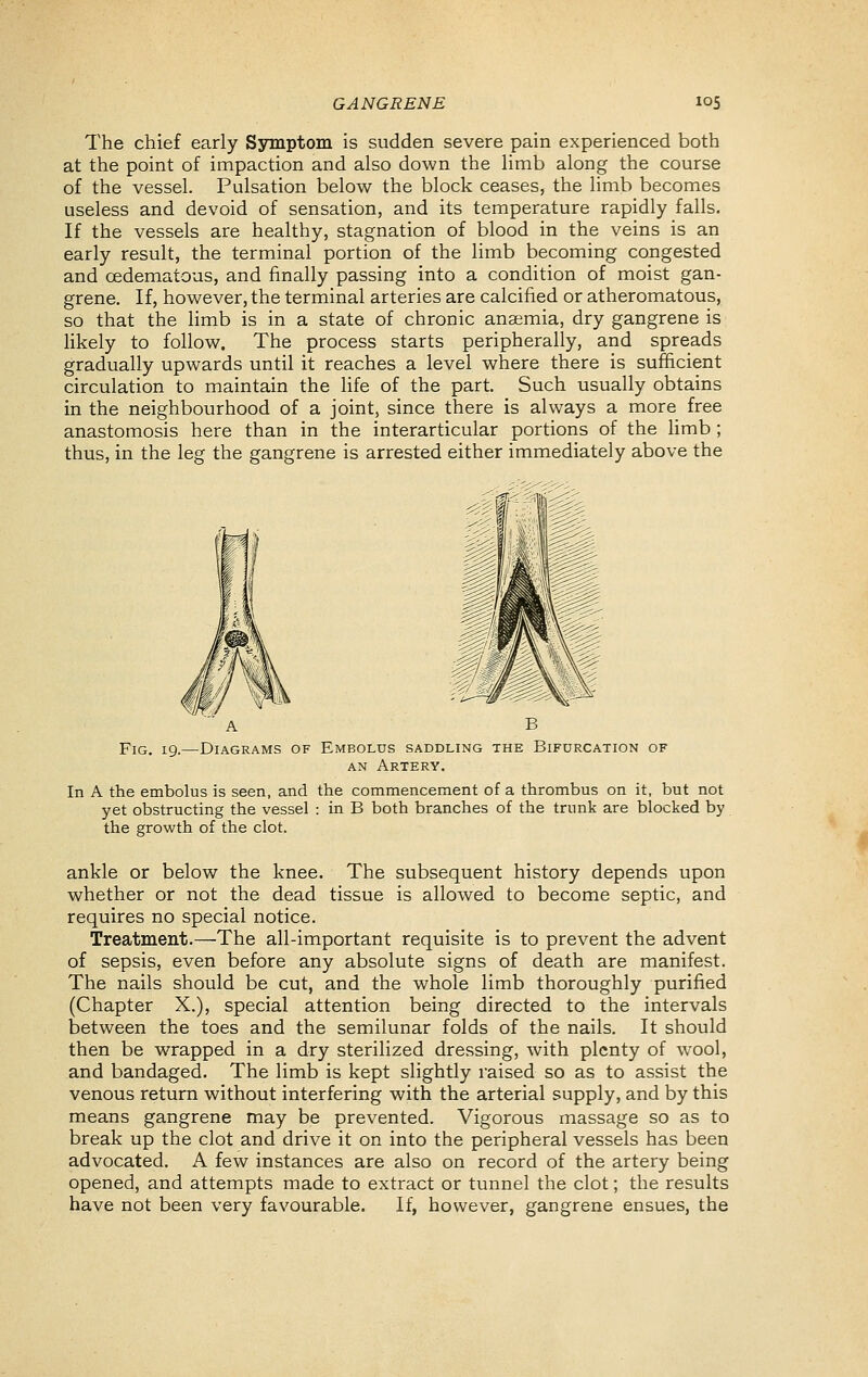 The chief early Symptom is sudden severe pain experienced both at the point of impaction and also down the limb along the course of the vessel. Pulsation below the block ceases, the limb becomes useless and devoid of sensation, and its temperature rapidly falls. If the vessels are healthy, stagnation of blood in the veins is an early result, the terminal portion of the limb becoming congested and cedematous, and finally passing into a condition of moist gan- grene. If, however, the terminal arteries are calcified or atheromatous, so that the limb is in a state of chronic anaemia, dry gangrene is likely to follow. The process starts peripherally, and spreads gradually upwards until it reaches a level where there is sufficient circulation to maintain the life of the part. Such usually obtains in the neighbourhood of a joint, since there is always a more free anastomosis here than in the interarticular portions of the limb ; thus, in the leg the gangrene is arrested either immediately above the A B Fig. 19.—Diagrams of Embolus saddling the Bifurcation of AN Artery. In A the embolus is seen, and the commencement of a thrombus on it, but not yet obstructing the vessel : in B both branches of the trunk are blocked by the growth of the clot. ankle or below the knee. The subsequent history depends upon whether or not the dead tissue is allowed to become septic, and requires no special notice. Treatment.—The all-important requisite is to prevent the advent of sepsis, even before any absolute signs of death are manifest. The nails should be cut, and the whole limb thoroughly purified (Chapter X.), special attention being directed to the intervals between the toes and the semilunar folds of the nails. It should then be wrapped in a dry sterilized dressing, with plenty of wool, and bandaged. The limb is kept slightly raised so as to assist the venous return without interfering with the arterial supply, and by this means gangrene may be prevented. Vigorous massage so as to break up the clot and drive it on into the peripheral vessels has been advocated. A few instances are also on record of the artery being opened, and attempts made to extract or tunnel the clot; the results have not been very favourable. If, however, gangrene ensues, the