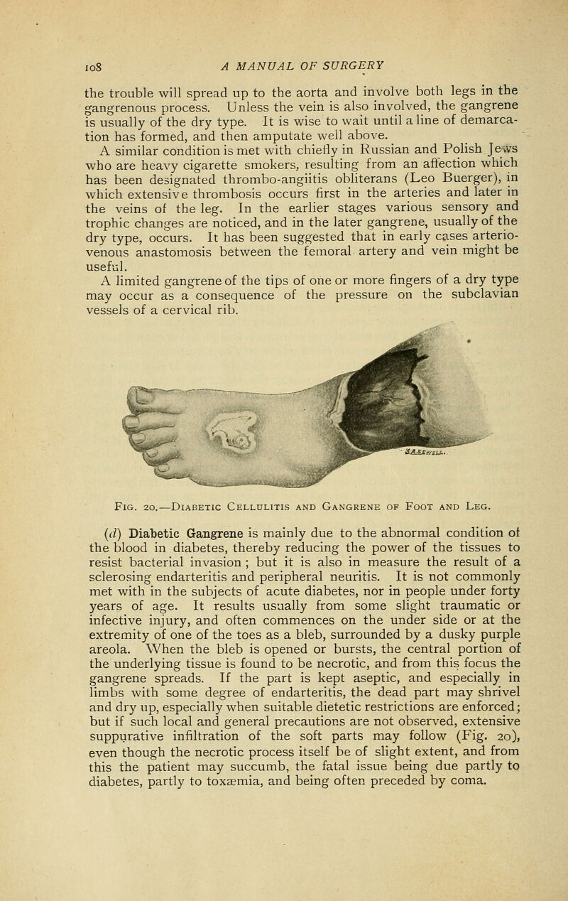 the trouble will spread up to the aorta and involve both legs in the gangrenous process. Unless the vein is also involved, the gangrene is usually of the dry type. It is wise to wait until a line of demarca- tion has formed, and then amputate well above. A similar condition is met with chiefly in Russian and Polish Je vvs who are heavy cigarette smokers, resulting from an affection which has been designated thrombo-angiitis obliterans (Leo Buerger), in which extensive thrombosis occurs first in the arteries and later in the veins of the leg. In the earlier stages various sensory and trophic changes are noticed, and in the later gangrene, usually of the dry type, occurs. It has been suggested that in early cases arterio- venous anastomosis between the femoral artery and vein might be useful. A limited gangrene of the tips of one or more fingers of a dry type may occur as a consequence of the pressure on the subclavian vessels of a cervical rib. Fig. 20.—Diabetic Cellulitis and Gangrene of Foot and Leg. (d) Diabetic Gangrene is mainly due to the abnormal condition of the blood in diabetes, thereby reducing the power of the tissues to resist bacterial invasion ; but it is also in measure the result of a sclerosing endarteritis and peripheral neuritis. It is not commonly met with in the subjects of acute diabetes, nor in people under forty years of age. It results usually from some slight traumatic or infective injury, and often commences on the under side or at the extremity of one of the toes as a bleb, surrounded by a dusky purple areola. When the bleb is opened or bursts, the central portion of the underlying tissue is found to be necrotic, and from this focus the gangrene spreads. If the part is kept aseptic, and especially in limbs with some degree of endarteritis, the dead part may shrivel and dry up, especially when suitable dietetic restrictions are enforced; but if such local and general precautions are not observed, extensive suppurative infiltration of the soft parts may follow (Fig. 20), even though the necrotic process itself be of sHght extent, and from this the patient may succumb, the fatal issue being due partly to diabetes, partly to toxsemia, and being often preceded by coma.