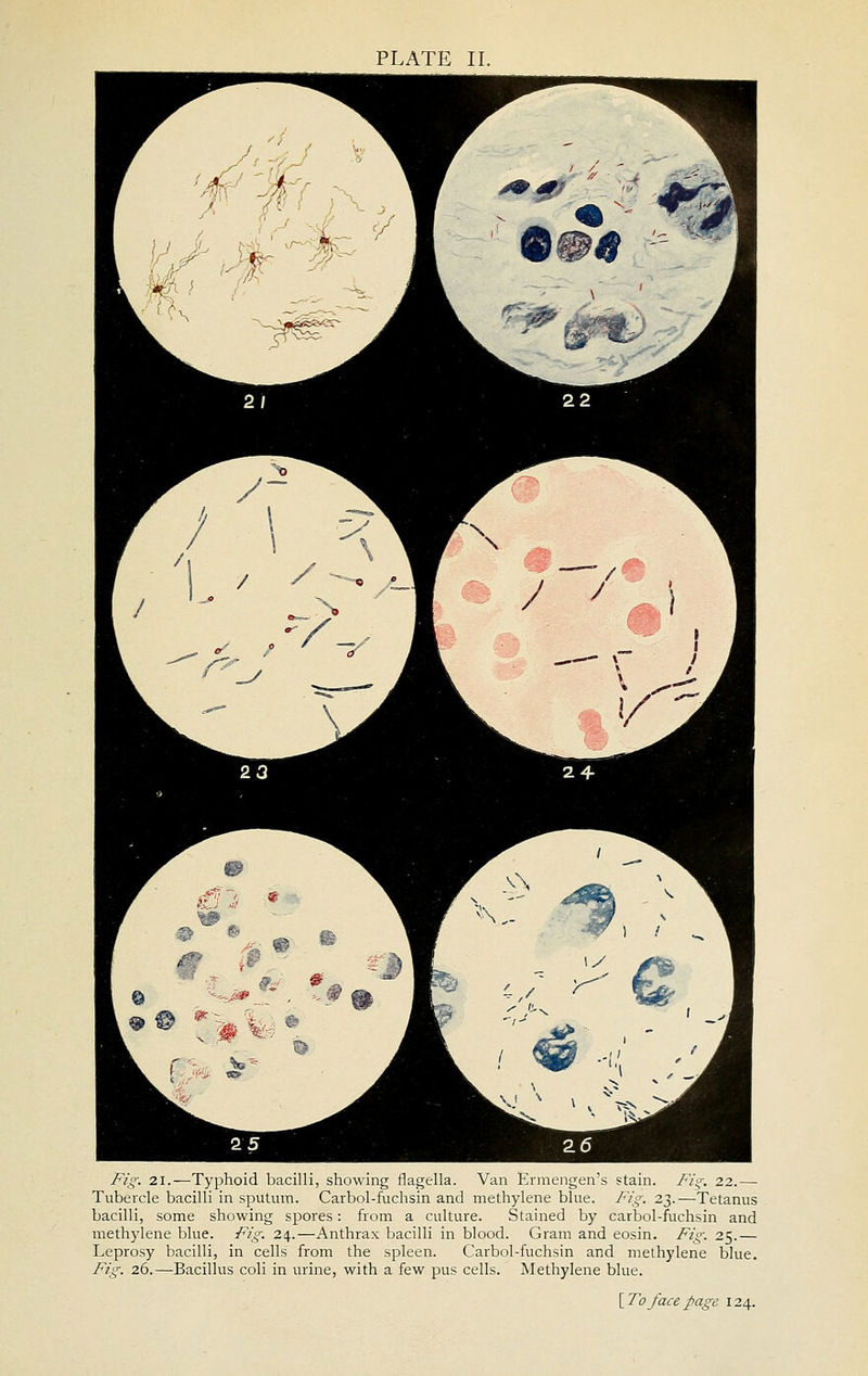 Fig. 21.—Typhoid bacilli, showing flagella. Van Ermengen's stain. Fig. 22.— Tubercle bacilli in sputiun. Carbol-fuchsin and methylene blue. Fig. 23.—Tetanus bacilli, some showing spores: from a culture. Stained by carbol-fuchsin and methylene blue. Fig. 24.—Anthrax bacilli in blood. Gram and eosin. Fig. 25.— Leprosy bacilli, in cells from the spleen. Carbol-fuchsin and methylene blue. Fig. 26.—Bacillus coli in urine, with a few pus cells. Methylene blue. {To face page 124.