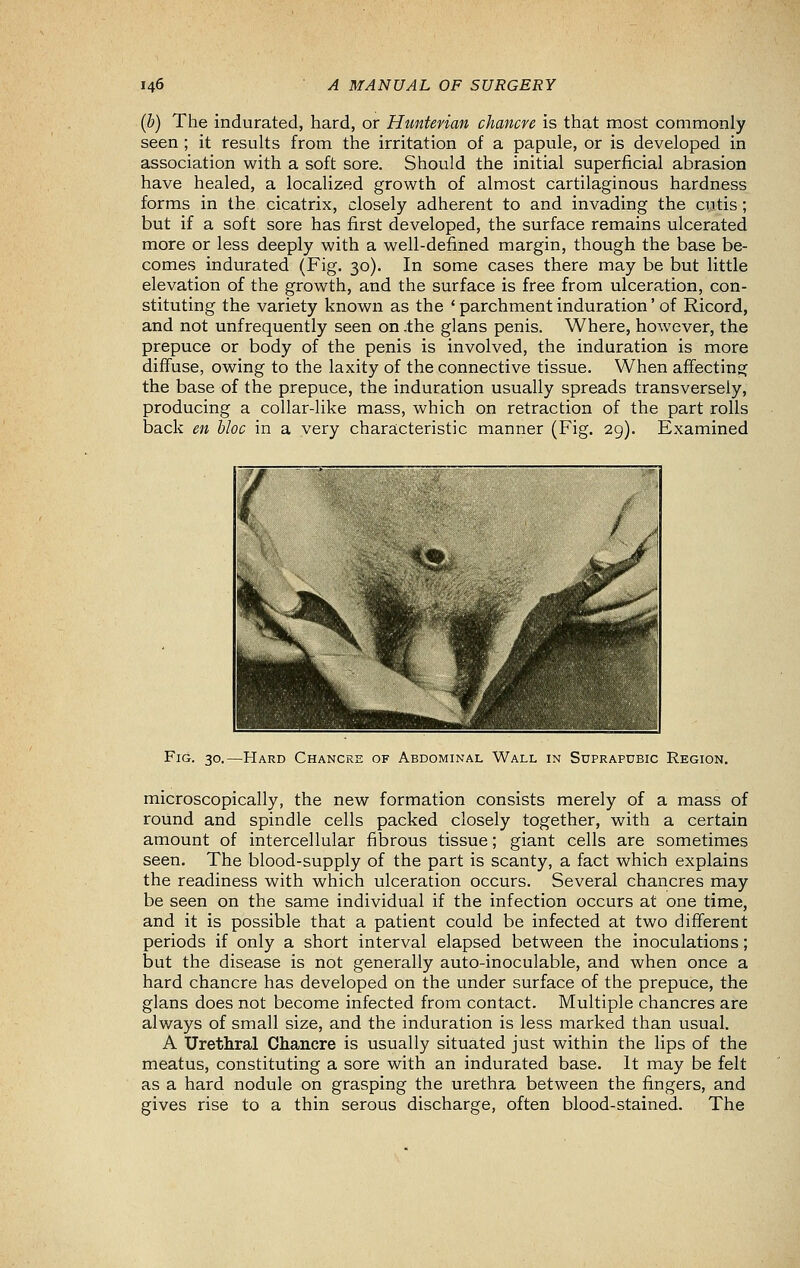 (b) The indurated, hard, or Huntevian chancre is that most commonly seen ; it results from the irritation of a papule, or is developed in association with a soft sore. Should the initial superficial abrasion have healed, a localized growth of almost cartilaginous hardness forms in the cicatrix, closely adherent to and invading the cutis; but if a soft sore has first developed, the surface remains ulcerated more or less deeply with a well-defined margin, though the base be- comes indurated (Fig. 30). In some cases there may be but little elevation of the growth, and the surface is free from ulceration, con- stituting the variety known as the ' parchment induration' of Ricord, and not unfrequently seen on .the glans penis. Where, however, the prepuce or body of the penis is involved, the induration is more diffuse, owing to the laxity of the connective tissue. When affecting the base of the prepuce, the induration usually spreads transversely, producing a collar-like mass, which on retraction of the part rolls back en bloc in a very characteristic manner (Fig. 29). Examined Fig. 30.—Hard Chancre of Abdominal Wall in Suprapubic Region. microscopically, the new formation consists merely of a mass of round and spindle cells packed closely together, with a certain amount of intercellular fibrous tissue; giant cells are sometimes seen. The blood-supply of the part is scanty, a fact which explains the readiness with which ulceration occurs. Several chancres may be seen on the same individual if the infection occurs at one time, and it is possible that a patient could be infected at two different periods if only a short interval elapsed between the inoculations; but the disease is not generally auto-inoculable, and when once a hard chancre has developed on the under surface of the prepuce, the glans does not become infected from contact. Multiple chancres are always of small size, and the induration is less marked than usual. A Urethral Chancre is usually situated just within the lips of the meatus, constituting a sore with an indurated base. It may be felt as a hard nodule on grasping the urethra between the fingers, and gives rise to a thin serous discharge, often blood-stained. The