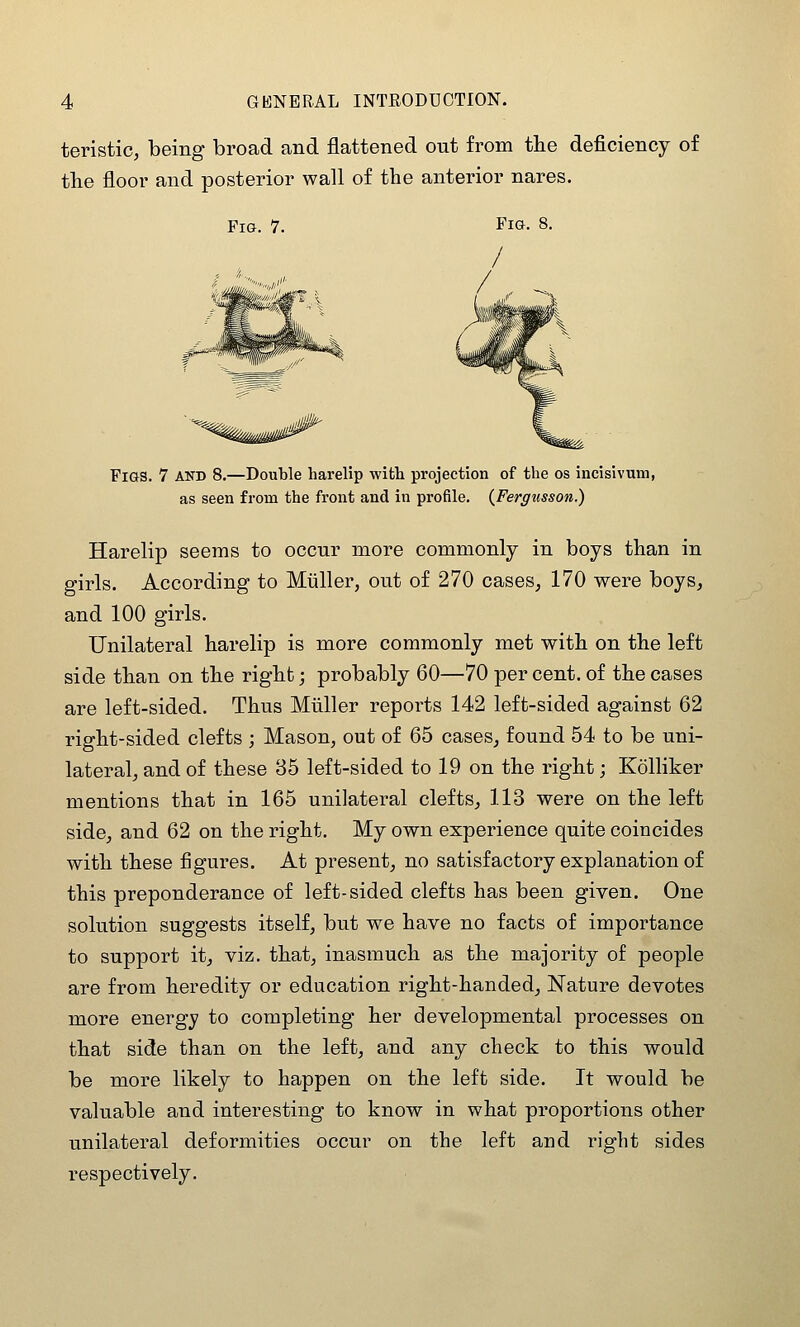 teristic, being broad and flattened out from the deficiency of the floor and posterior wall of the anterior nares. Fig. 7. Fig. 8. Figs. 7 and 8.—Double harelip with projection of the os incisivum, as seen from the front and in profile. {Fergusson.) Harelip seems to occur more commonly in boys than in girls. According to Miiller, out of 270 cases^ 170 were boys, and 100 girls. Unilateral harelip is more commonly met with on the left side than on the right; probably 60—70 per cent, of the cases are left-sided. Thus Miiller reports 142 left-sided against 62 right-sided clefts ; Mason, out of 65 cases, found 54 to be uni- lateral, and of these 85 left-sided to 19 on the right; Kolliker mentions that in 165 unilateral clefts, 113 were on the left side, and 62 on the right. My own experience quite coincides with these figures. At present, no satisfactory explanation of this preponderance of left-sided clefts has been given. One solution suggests itself, but we have no facts of importance to support it, viz. that, inasmuch as the majority of people are from heredity or education right-handed. Nature devotes more energy to completing her developmental processes on that side than on the left, and any check to this would be more likely to happen on the left side. It would be valuable and interesting- to know in what proportions other unilateral deformities occur on the left and right sides respectively.