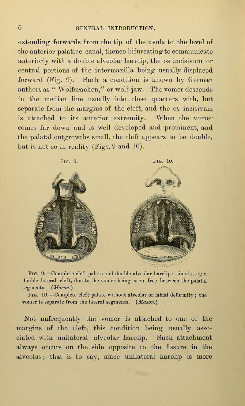 extending forwards from the tip of tlie uvula to the level of the anterior palatine canal, thence bifurcating to communicate anteriorly with a double alveolar harelip, the os incisivum or central portions of the intermaxilla being usually displaced forward (Fig. 9). Such a condition is known by German authors as  Wolfsrachen, or wolf-jaw. The vomer descends in the median line usually into close quarters with^ but separate from the margins of the cleft, and the os incisivum is attached to its anterior extremity. When the vomer comes far down and is well developed and prominent, and the palatal outgrowths small, the cleft appears to be double, but is not so in reality (Figs. 9 and 10). Fia. 10. Fia. 9.—Complete cleft pulate and double alveolar harelip ; simulating a double lateral cleft, due to the vouicr being seen free between the palatal segments. (^Mason.) Fig. 10.—Complete cleft palate without alveolar or labial deformity ; the vomer is separate from the lateral segments. {Mason.) Not unfrequently the vomer is attached to one of the margins of the cleft, this condition being usually asso- ciated with unilateral alveolar harelip. Such attachment always occurs on the side opposite to the fissure in the alveolus; that is to say, since unilateral harelip is more