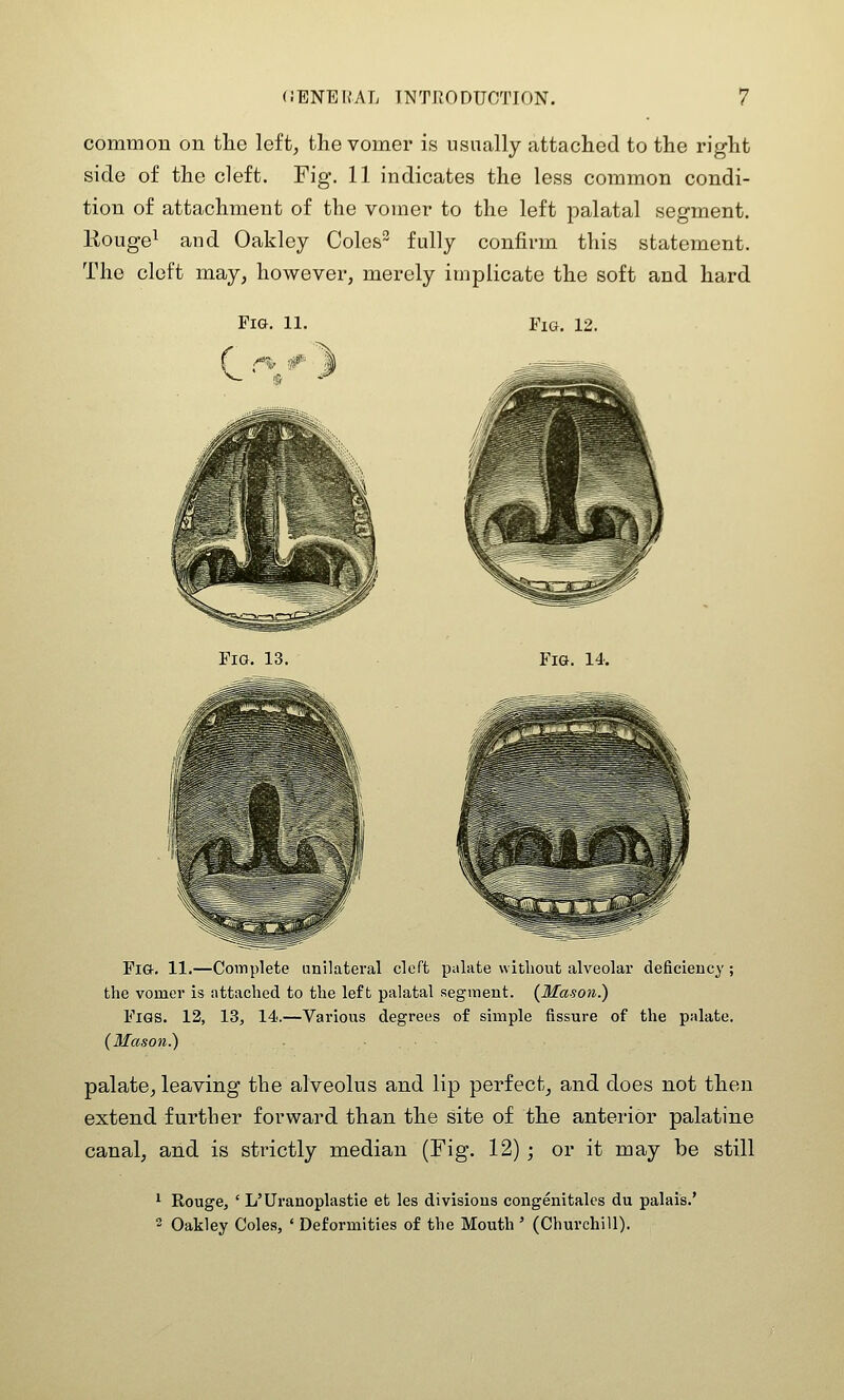 common on tHe left, the vomer is usually attached to the right side of the cleft. Fig. 11 indicates the less common condi- tion of attachment of the vomer to the left palatal segment. Rouge^ and Oakley Coles^ fully confirm this statement. The cleft may, however, merely implicate the soft and hard Fig. 12. Fio. 13. Fig. 14. Fl&. 11.—Complete eral cleft palate without alveolar deficiency; the vomer is attached to the left palatal segment. (Mason.) Figs. 12, 13, 14.—Various degrees of simple fissure of the palate. (3Iason.) palate, leaving the alveolus and lip perfect, and does not then extend further forward than the site of the anterior palatine canal, and is strictly median (Fig. 12); or it may be still ^ Rouge, ' L'Uranoplastie et les divisions congenitales du palais.' 2 Oakley Coles, ' Deformities of the Mouth ' (Churchill).