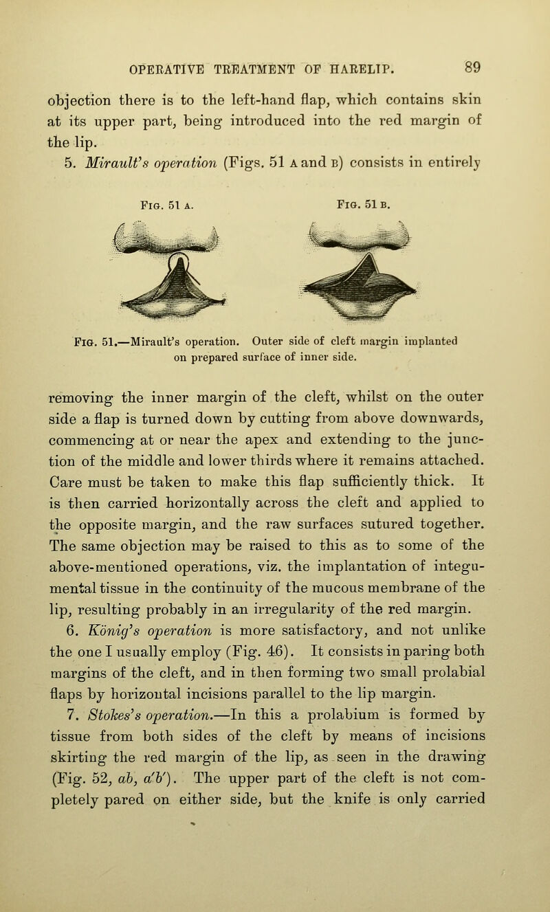 objection there is to the left-hand flap, which contains stin at its upper part, being introduced into the red margin of the lip. 5. MirauWs operation (Figs. 51 a and b) consists in entirely Fig. 51 a. Pig. 51.—Mirault's operation. Outer side of cleft margin implanted on prepared surface of inner side. removing the inner margin of the cleft, whilst on the outer side a flap is turned down by cutting from above downwards, commencing at or near the apex and extending to the junc- tion of the middle and lower thirds where it remains attached. Care must be taken to make this flap sufficiently thick. It is then carried horizontally across the cleft and applied to the opposite margin, and the raw surfaces sutured together. The same objection may be raised to this as to some of the above-mentioned operations, viz. the implantation of integu- mental tissue in the continuity of the mucous membrane of the lip, resulting probably in an irregularity of the red margin. 6. Konig's operation is more satisfactory, and not unlike the one I usually employ (Fig. 46). It consists in paring both margins of the cleft, and in then forming two small prolabial flaps by horizontal incisions parallel to the lip margin. 7. Stohes's operation.—In this a prolabium is formed by tissue from both sides of the cleft b}^ means of incisions skirting the red margin of the lip, as seen in the drawing (Fig. 52, ah, a'h'). The upper part of the cleft is not com- pletely pared on either side, but the knife is only carried