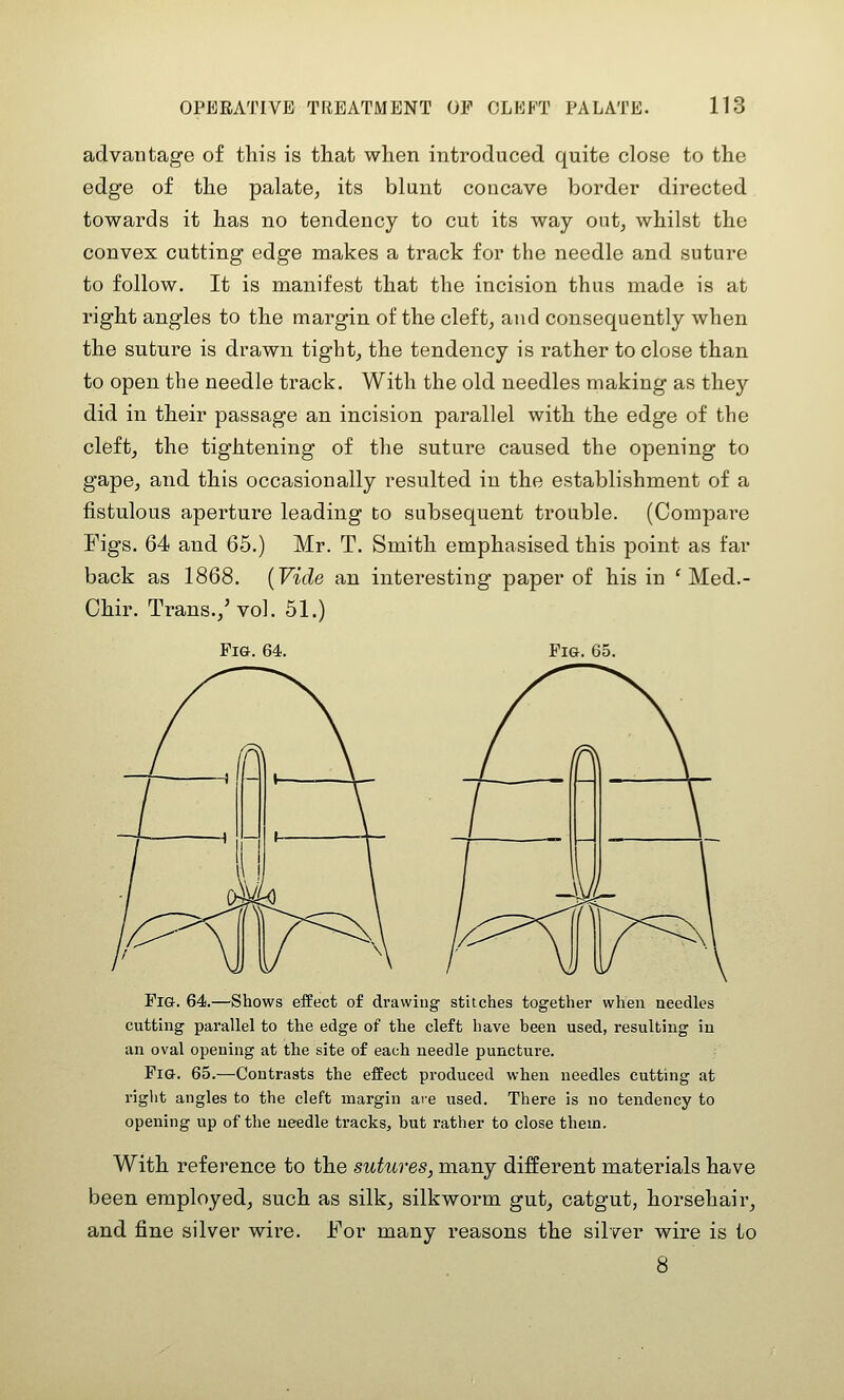 advantage of this is that when introduced quite close to the edge of the palate^ its blunt concave border directed towards it has no tendency to cut its way out, whilst the convex cutting edge makes a track for the needle and suture to follow. It is manifest that the incision thus made is at right angles to the margin of the cleft, and consequently Avhen the suture is drawn tight, the tendency is rather to close than to open the needle track. With the old needles making as they did in their passage an incision parallel with the edge of the cleft, the tightening of the suture caused the opening to gape, and this occasionally resulted in the establishment of a fistulous aperture leading to subsequent trouble. (Compare Figs. 64 and 65.) Mr. T. Smith emphasised this point as far back as 1868. {Vide an interesting paper of his in ' Med.- Chir. Trans.,'vol. 51.) Fi&. 64. Pig. 65. Fig. 64.—Shows effect of drawing stitches together when needles cutting parallel to the edge of the cleft have been used, resulting in an oval opening at the site of each needle puncture. Fig. 65.—Contrasts the effect produced when needles cutting at right angles to the cleft margin are used. There is no tendency to opening up of the needle tracks, but rather to close thein. With reference to the sutures, many different materials have been employed, such as silk, silkworm gut, catgut, horsehair, and fine silver wire. For many reasons the silver wire is to 8