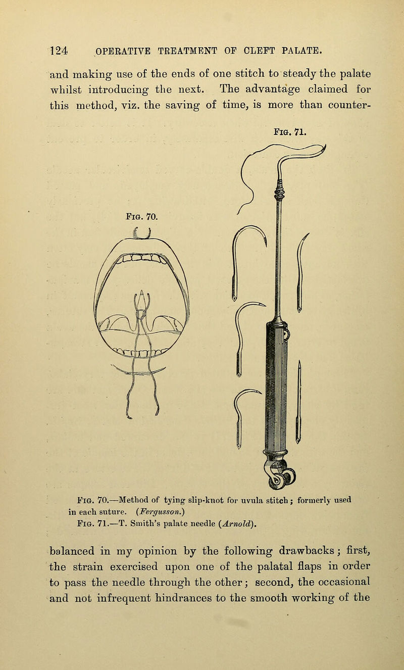 and making use of the ends of one stitch to steady the palate whilst introducing the next. The advantage claimed for this method, viz. the saving of time, is more than counter- Fia. 71. Fio. 70. Fig. 70.—Method of tying slip-knot for uvula stitcb j formerly used in each suture. (Fergusson.) Fig. 71.—T. Smith's palate needle (^Arnold), balanced in my opinion by the following dravrbacks j first, the strain exercised upon one of the palatal flaps in order to pass the needle through the other; second, the occasional and not infrequent hindrances to the smooth working of the