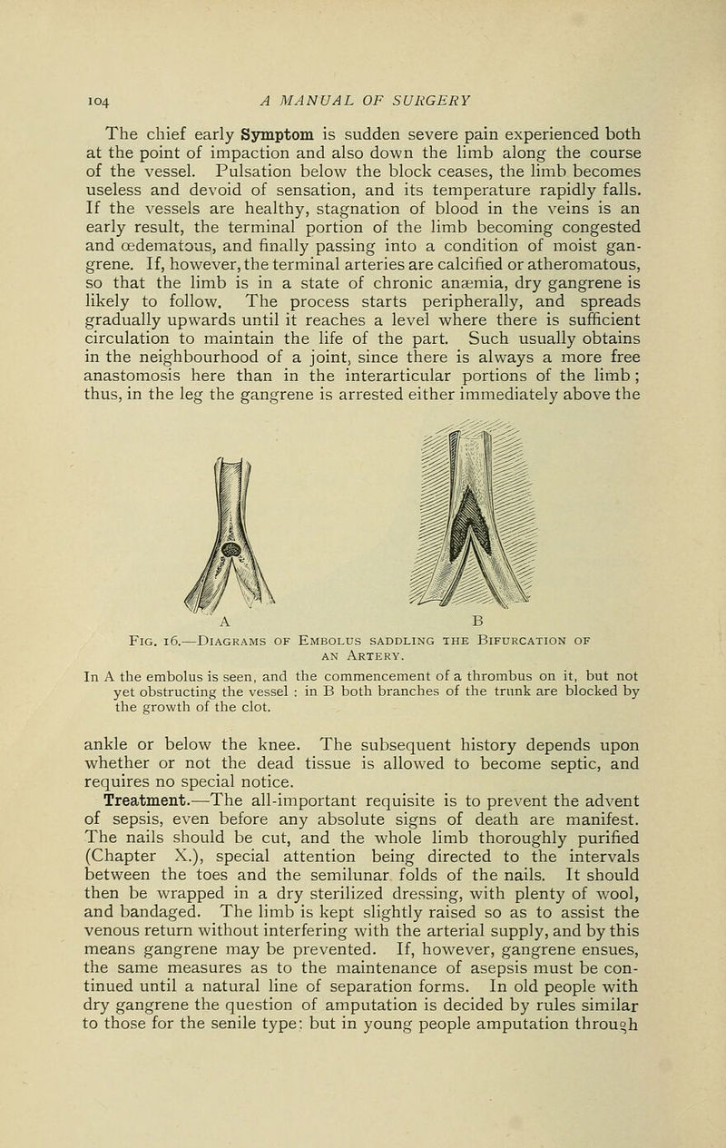 The chief early Symptom is sudden severe pain experienced both at the point of impaction and also down the limb along the course of the vessel. Pulsation below the block ceases, the limb becomes useless and devoid of sensation, and its temperature rapidly falls. If the vessels are healthy, stagnation of blood in the veins is an early result, the terminal portion of the limb becoming congested and cedematous, and finally passing into a condition of moist gan- grene. If, however, the terminal arteries are calcified or atheromatous, so that the limb is in a state of chronic anaemia, dry gangrene is likely to follow. The process starts peripherally, and spreads gradually upwards until it reaches a level where there is sufficient circulation to maintain the life of the part. Such usually obtains in the neighbourhood of a joint, since there is always a more free anastomosis here than in the interarticular portions of the limb ; thus, in the leg the gangrene is arrested either immediately above the A B Fig. 16.—Diagrams of Embolus saddling the Bifurcation of an Artery. In A the embolus is seen, and the commencement of a thrombus on it, but not yet obstructing the vessel : in B both branches of the trunk are blocked by the growth of the clot. ankle or below the knee. The subsequent history depends upon whether or not the dead tissue is allowed to become septic, and requires no special notice. Treatment.—The all-important requisite is to prevent the advent of sepsis, even before any absolute signs of death are manifest. The nails should be cut, and the whole limb thoroughly purified (Chapter X.), special attention being directed to the intervals between the toes and the semilunar folds of the nails. It should then be wrapped in a dry sterilized dressing, with plenty of wool, and bandaged. The limb is kept slightly raised so as to assist the venous return without interfering with the arterial supply, and by this means gangrene may be prevented. If, however, gangrene ensues, the same measures as to the maintenance of asepsis must be con- tinued until a natural line of separation forms. In old people with dry gangrene the question of amputation is decided by rules similar to those for the senile type; but in young people amputation through