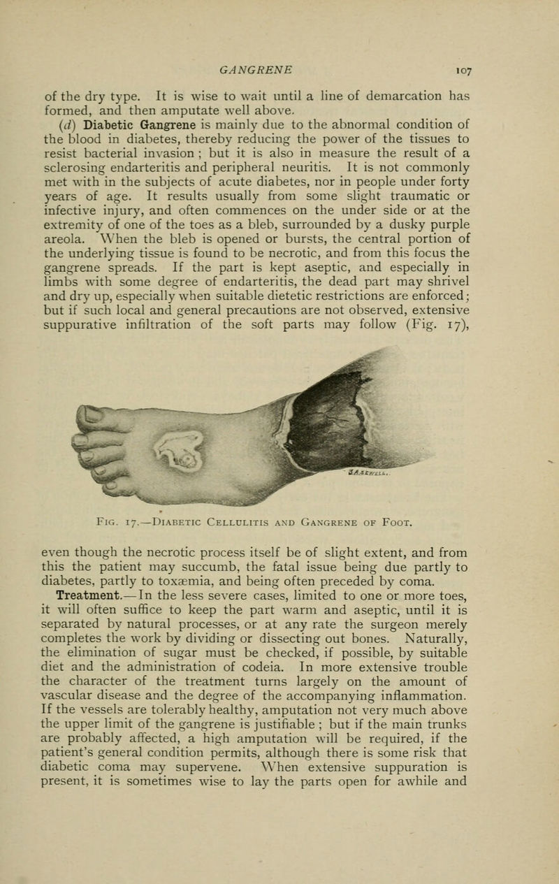 of the dry type. It is wise to wait until a line of demarcation has formed, and then amputate well above. (ci) Diabetic Gangrene is mainly due to the abnormal condition of the blood in diabetes, thereby reducing the power of the tissues to resist bacterial invasion ; but it is also in measure the result of a sclerosing endarteritis and peripheral neuritis. It is not commonly met with in the subjects of acute diabetes, nor in people under forty years of age. It results usually from some slight traumatic or infective injury, and often commences on the under side or at the extremity of one of the toes as a bleb, surrounded by a dusky purple areola. When the bleb is opened or bursts, the central portion of the underlying tissue is found to be necrotic, and from this focus the gangrene spreads. If the part is kept aseptic, and especially in limbs with some degree of endarteritis, the dead part may shrivel and dry up, especially when suitable dietetic restrictions are enforced; but if such local and general precautions are not observed, extensive suppurative infiltration of the soft parts may follow (Fig. 17), Fig. 17.—Diabetic Cellulitis and Gangrene of Foot. even though the necrotic process itself be of slight extent, and from this the patient may succumb, the fatal issue being due partly to diabetes, partly to toxaemia, and being often preceded by coma. Treatment.—In the less severe cases, limited to one or more toes, it will often suffice to keep the part warm and aseptic, until it is separated by natural processes, or at any rate the surgeon merely completes the work by dividing or dissecting out bones. Naturally, the elimination of sugar must be checked, if possible, by suitable diet and the administration of codeia. In more extensive trouble the character of the treatment turns largely on the amount of vascular disease and the degree of the accompanying inflammation. If the vessels are tolerably healthy, amputation not very much above the upper limit of the gangrene is justifiable ; but if the main trunks are probably affected, a high amputation will be required, if the patient's general condition permits, although there is some risk that diabetic coma may supervene. When extensive suppuration is present, it is sometimes wise to lay the parts open for awhile and