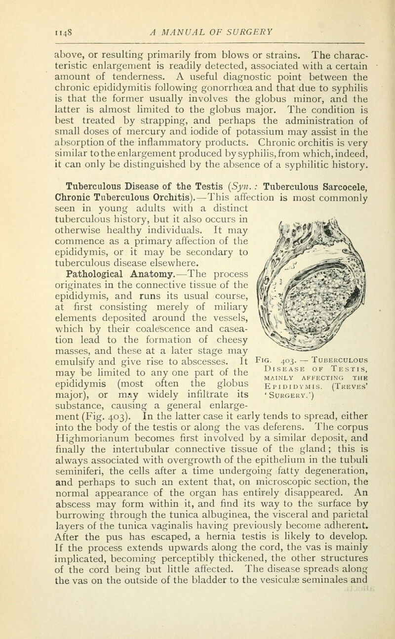 above, or resulting primarily from blows or strains. The charac- teristic enlargement is readily detected, associated with a certain amount of tenderness. A useful diagnostic point between the chronic epididymitis following gonorrhoea and that due to syphilis is that the former usually involves the globus minor, and the latter is almost limited to the globus major. The condition is best treated by strapping, and perhaps the administration of small doses of mercury and iodide of potassium may assist in the absorption of the inflammatory products. Chronic orchitis is very similar to the enlargement produced by syphilis, from which, indeed, it can only be distinguished by the absence of a syphilitic history. Tuberculous Disease of the Testis (Syn.: Tuberculous Sarcocele, Chronic Tuberculous Orchitis).—This affection is most commonly seen in young adults with a distinct tuberculous history, but it also occurs in otherwise healthy individuals. It may commence as a primary affection of the epididymis, or it may be secondary to tuberculous disease elsewhere. Pathological Anatomy.—The process originates in the connective tissue of the epididymis, and runs its usual course, at first consisting merely of miliary elements deposited around the vessels, which by their coalescence and casea- tion lead to the formation of cheesy masses, and these at a later stage may emulsify and give rise to abscesses. It may be limited to any one part of the epididymis (most often the globus major), or may widely infiltrate its substance, causing a general enlarge- ment (Fig. 403). In the latter case it early tends to spread, either into the body of the testis or along the vas deferens. The corpus Highmorianum becomes first involved by a similar deposit, and finally the intertubular connective tissue of the gland ; this is always associated with overgrowth of the epithelium in the tubuli seminiferi, the cells after a time undergoing fatty degeneration, and perhaps to such an extent that, on microscopic section, the normal appearance of the organ has entirely disappeared. An abscess may form within it, and find its way to the surface by burrowing through the tunica albuginea, the visceral and parietal layers of the tunica vaginalis having previously become adherent. After the pus has escaped, a hernia testis is likely to develop. If the process extends upwards along the cord, the vas is mainly implicated, becoming perceptibly thickened, the other structures of the cord being but little affected. The disease spreads along the vas on the outside of the bladder to the vesicular seminales and Fig. 403. — Tuberculous Disease of Testis, mainly affecting the Epididymis. (Treves' ' Surgery.')