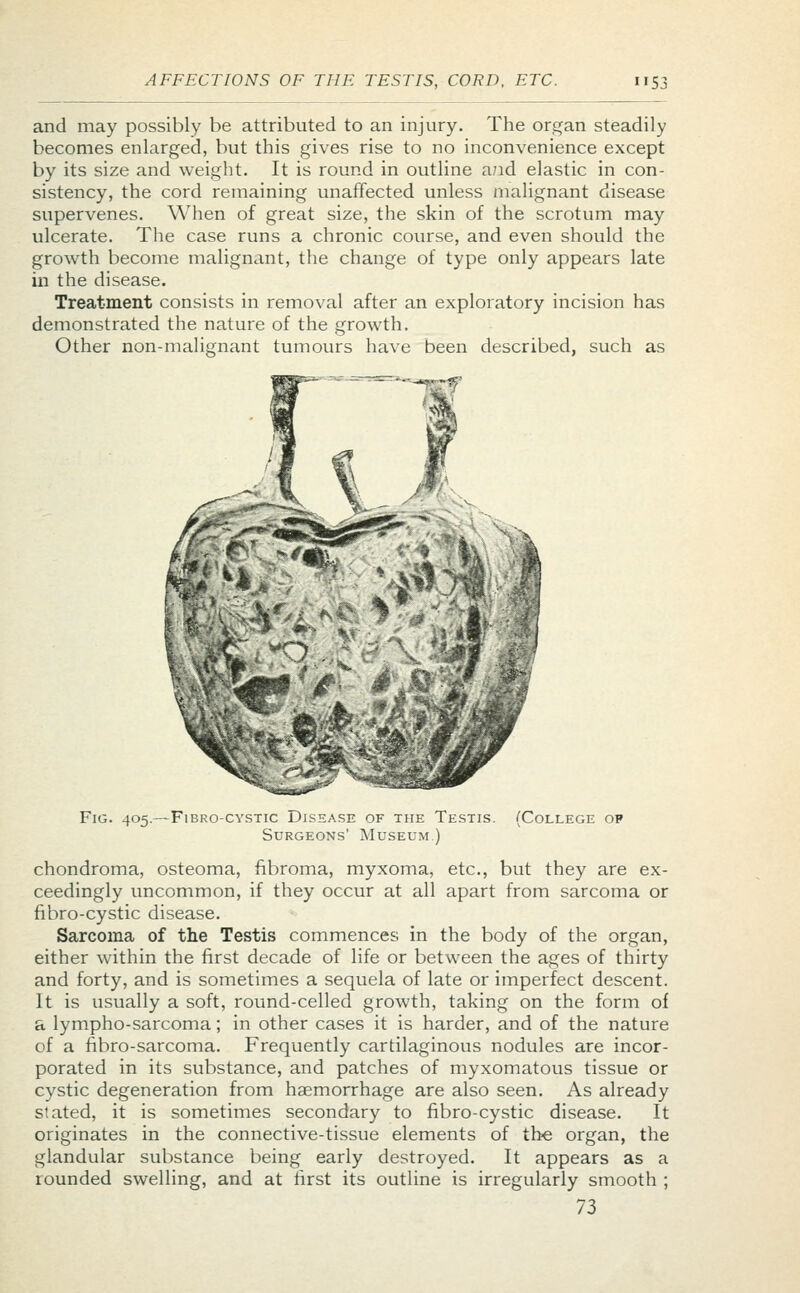 and may possibly be attributed to an injury. The organ steadily becomes enlarged, but this gives rise to no inconvenience except by its size and weight. It is round in outline a/id elastic in con- sistency, the cord remaining unaffected unless malignant disease supervenes. When of great size, the skin of the scrotum may ulcerate. The case runs a chronic course, and even should the growth become malignant, the change of type only appears late in the disease. Treatment consists in removal after an exploratory incision has demonstrated the nature of the growth. Other non-malignant tumours have been described, such as Fig. 405. -Fibrocystic Disease of the Testis. Surgeons' Museum ) (College op chondroma, osteoma, fibroma, myxoma, etc., but they are ex- ceedingly uncommon, if they occur at all apart from sarcoma or fibro-cystic disease. Sarcoma of the Testis commences in the body of the organ, either within the first decade of life or between the ages of thirty and forty, and is sometimes a sequela of late or imperfect descent. It is usually a soft, round-celled growth, taking on the form of a lympho-sarcoma; in other cases it is harder, and of the nature of a nbro-sarcoma. Frequently cartilaginous nodules are incor- porated in its substance, and patches of myxomatous tissue or cystic degeneration from haemorrhage are also seen. As already stated, it is sometimes secondary to fibro-cystic disease. It originates in the connective-tissue elements of the organ, the glandular substance being early destroyed. It appears as a rounded swelling, and at first its outline is irregularly smooth ; 73