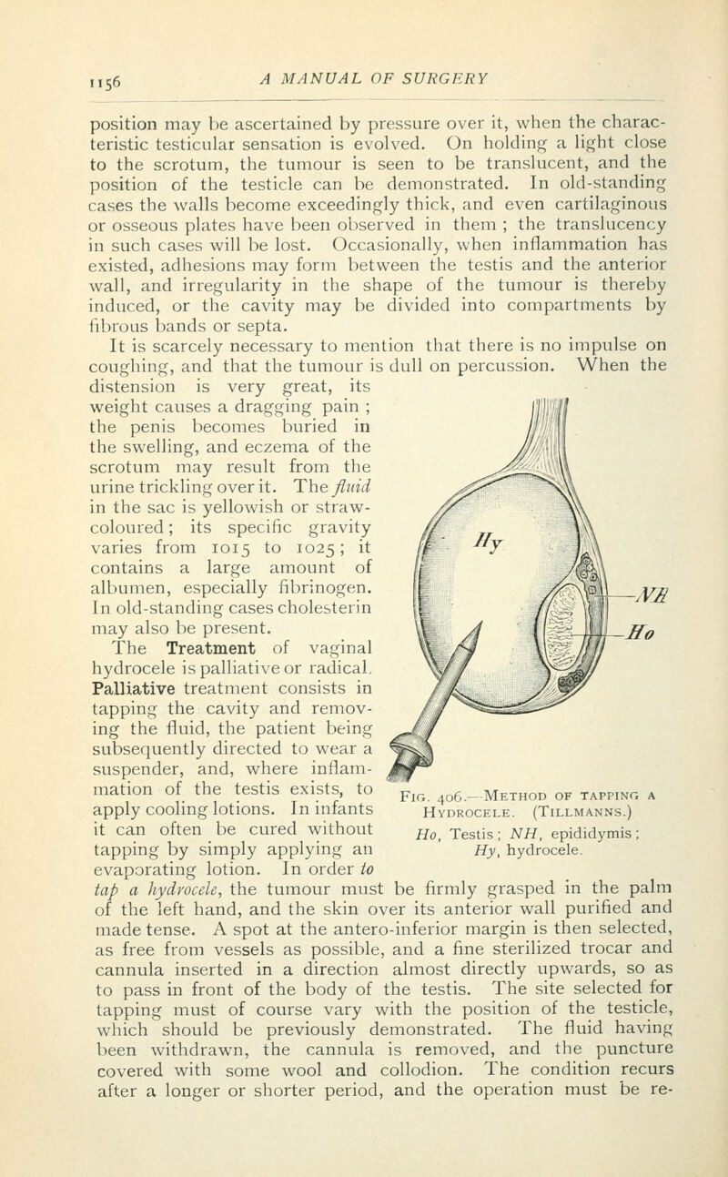 ME position may be ascertained by pressure over it, when the charac- teristic testicular sensation is evolved. On holding a light close to the scrotum, the tumour is seen to be translucent, and the position of the testicle can be demonstrated. In old-standing cases the walls become exceedingly thick, and even cartilaginous or osseous plates have been observed in them ; the translucency in such cases will be lost. Occasionally, when inflammation has existed, adhesions may form between the testis and the anterior wall, and irregularity in the shape of the tumour is thereby induced, or the cavity may be divided into compartments by fibrous bands or septa. It is scarcely necessary to mention that there is no impulse on coughing, and that the tumour is dull on percussion. When the distension is very great, its weight causes a dragging pain ; the penis becomes buried in the swelling, and eczema of the scrotum may result from the urine trickling over it. The fluid in the sac is yellowish or straw- coloured ; its specific gravity varies from 1015 to 1025; it contains a large amount of albumen, especially fibrinogen. In old-standing cases cholesterin may also be present. The Treatment of vaginal hydrocele is palliative or radical. Palliative treatment consists in tapping the cavity and remov- ing the fluid, the patient being subsequently directed to wear a suspender, and, where inflam- mation of the testis exists, to apply cooling lotions. In infants it can often be cured without tapping by simply applying an evaporating lotion. In order to tap a hydrocele, the tumour must be firmly grasped in the palm of the left hand, and the skin over its anterior wall purified and made tense. A spot at the antero-inferior margin is then selected, as free from vessels as possible, and a fine sterilized trocar and cannula inserted in a direction almost directly upwards, so as to pass in front of the body of the testis. The site selected for tapping must of course vary with the position of the testicle, which should be previously demonstrated. The fluid having been withdrawn, the cannula is removed, and the puncture covered with some wool and collodion. The condition recurs after a longer or shorter period, and the operation must be re- Fig. 406.—Method of tapping a Hydrocele. (Tillmanns.) Ho, Testis; NH, epididymis; Hy, hydrocele.