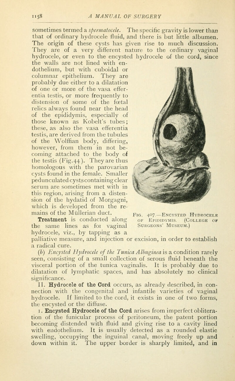 sometimes termed a spermatocele. The specific gravity is lower than that of ordinary hydrocele fluid, and there is but little albumen. The origin of these cysts has given rise to much discussion. They are of a very different nature to the ordinal y vaginal hydrocele, or even to the encysted hydrocele of the cord, since the walls are not lined with en- dothelium, but with cuboidal or columnar epithelium. They are probably due either to a dilatation of one or more of the vasa effer- entia testis, or more frequently to distension of some of the fcetal relics always found near the head of the epididymis, especially of those known as Kobelt's tubes; these, as also the vasa efferentia testis, are derived from the tubules of the Wolffian body, differing, however, from them in not be- coming attached to the body of the testis (Fig.44). They are thus homologous with the parovarian cysts found in the female. Smaller pedunculated cysts containing clear \ serum are sometimes met with in vj this region, arising from a disten- sion of the hydatid of Morgagni, which is developed from the re- mains of the Mullerian duct. Treatment is conducted along the same lines as for vaginal hydrocele, viz., by tapping as a palliative measure, and injection or excision, in order to establish a radical cure. (b) Encysted Hydrocele of the Tunica A Ibuginea is a condition rarely seen, consisting of a small collection of serous fluid beneath the visceral portion of the tunica vaginalis. It is probably due to dilatation of lymphatic spaces, and has absolutely no clinical significance. II. Hydrocele of the Cord occurs, as already described, in con- nection with the congenital and infantile varieties of vaginal hydrocele. If limited to the cord, it exists in one of two forms, the encysted or the diffuse. i. Encysted Hydrocele of the Cord arises from imperfect oblitera- tion of the funicular process of peritoneum, the patent portion becoming distended with fluid and giving rise to a cavity lined with endothelium. It is usually detected as a rounded elastic swelling, occupying the inguinal canal, moving freely up and down within it. The upper border is sharply limited, and in Fig. 407.—Encysted Hydrocele of Epididymis. (College of Surgeons' Museum.)