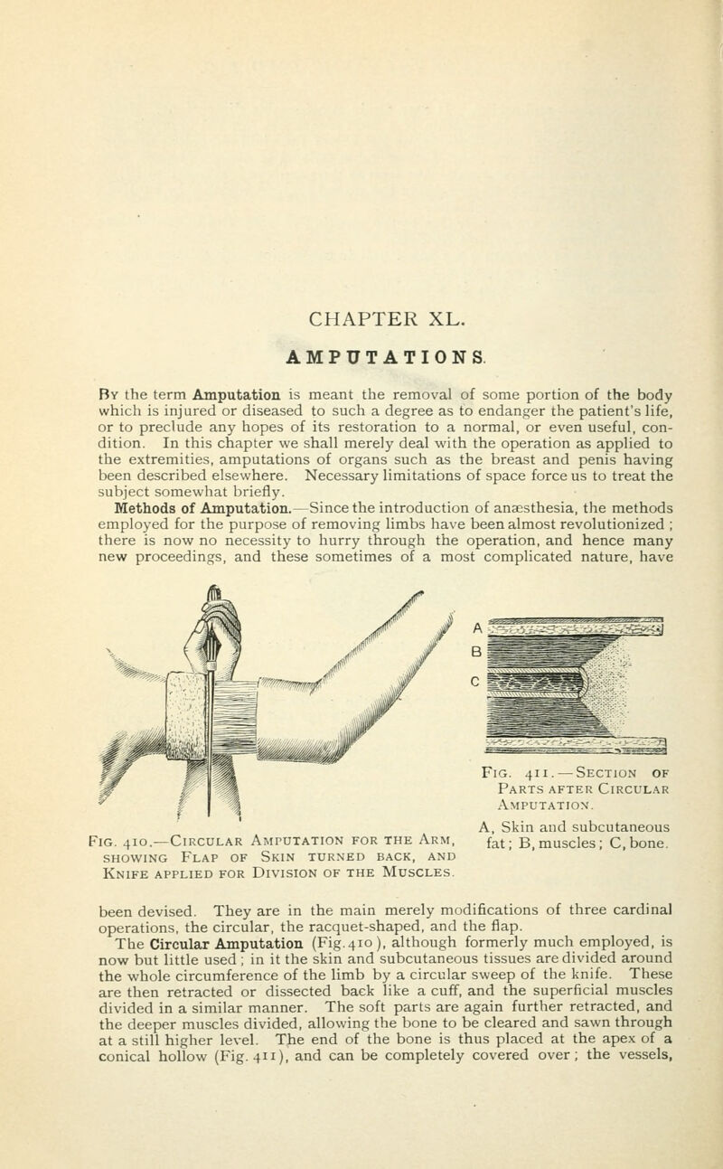 CHAPTER XL. AMPUTATIONS By the term Amputation is meant the removal of some portion of the body which is injured or diseased to such a degree as to endanger the patient's life, or to preclude any hopes of its restoration to a normal, or even useful, con- dition. In this chapter we shall merely deal with the operation as applied to the extremities, amputations of organs such as the breast and penis having been described elsewhere. Necessary limitations of space force us to treat the subject somewhat briefly. Methods of Amputation.—Since the introduction of anaesthesia, the methods employed for the purpose of removing limbs have been almost revolutionized ; there is now no necessity to hurry through the operation, and hence many new proceedings, and these sometimes of a most complicated nature, have Fig. 410.—Circular Amputation for the Arm, showing Flap of Skin turned back, and Knife applied for Division of the Muscles. Fig. 411. — Section of Parts after Circular Amputation. A, Skin and subcutaneous fat; B, muscles; C.bone. been devised. They are in the main merely modifications of three cardinal operations, the circular, the racquet-shaped, and the flap. The Circular Amputation (Fig. 410), although formerly much employed, is now but little used ; in it the skin and subcutaneous tissues are divided around the whole circumference of the limb by a circular sweep of the knife. These are then retracted or dissected back like a cuff, and the superficial muscles divided in a similar manner. The soft parts are again further retracted, and the deeper muscles divided, allowing the bone to be cleared and sawn through at a still higher level. The end of the bone is thus placed at the apex of a conical hollow (Fig. 411), and can be completely covered over; the vessels,