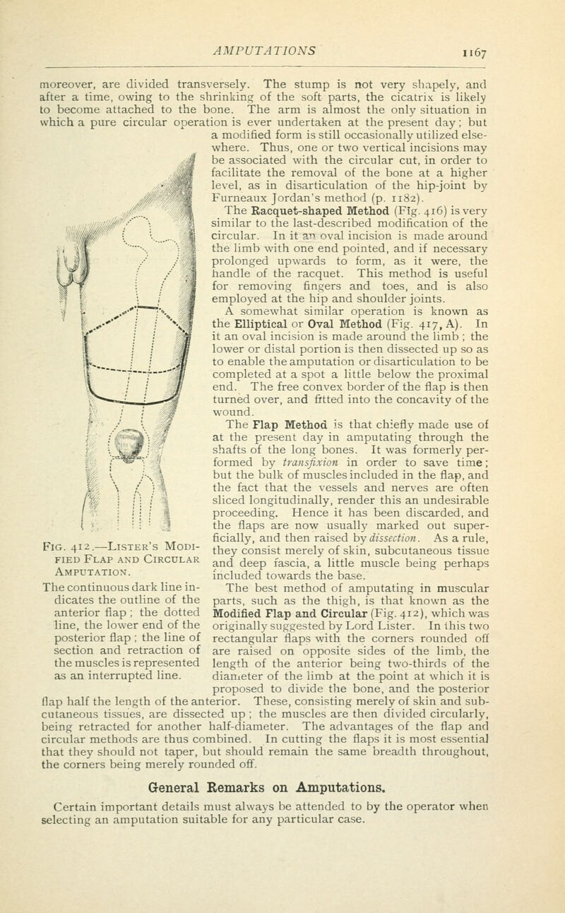 moreover, are divided transversely. The stump is not very shapely, and after a time, owing to the shrinking; of the soft parts, the cicatrix is likely to become attached to the bone. The arm is almost the only situation in which a pure circular operation is ever undertaken at the present day; but a modified form is still occasionally utilized else- where. Thus, one or two vertical incisions may be associated with the circular cut, in order to facilitate the removal of the bone at a higher level, as in disarticulation of the hip-joint by Furneaux Jordan's method (p. 1182). The Racquet-shaped Method (Fig. 416) is very similar to the last-described modification of the circular. In it an oval incision is made around the limb with one end pointed, and if necessary prolonged upwards to form, as it were, the handle of the racquet. This method is useful for removing fingers and toes, and is also employed at the hip and shoulder joints. A somewhat similar operation is known as the Elliptical or Oval Method (Fig. 417, A). In it an oval incision is made around the limb ; the lower or distal portion is then dissected up so as to enable the amputation or disarticulation to be completed at a spot a little below the proximal end. The free convex border of the flap is then turned over, and fitted into the concavity of the wound. The Flap Method is that chiefly made use of at the present day in amputating through the shafts of the long bones. It was formerly per- formed by transfixion in order to save time; but the bulk of muscles included in the flap, and the fact that the vessels and nerves are often sliced longitudinally, render this an undesirable proceeding. Hence it has been discarded, and the flaps are now usually marked out super- ficially, and then raised by dissection. As a rule, they consist merely of skin, subcutaneous tissue and deep fascia, a little muscle being perhaps included towards the base. The best method of amputating in muscular parts, such as the thigh, is that known as the Modified Flap and Circular (Fig. 412), which was originally suggested by Lord Lister. In this two rectangular flaps with the corners rounded off are raised on opposite sides of the limb, the length of the anterior being two-thirds of the diameter of the limb at the point at which it is proposed to divide the bone, and the posterior flap half the length of the anterior. These, consisting merely of skin and sub- cutaneous tissues, are dissected up ; the muscles are then divided circularly, being retracted for another half-diameter. The advantages of the flap and circular methods are thus combined. In cutting the flaps it is most essential that they should not taper, but should remain the same breadth throughout, the corners being merely rounded off. General Remarks on Amputations. Certain important details must always be attended to by the operator when selecting an amputation suitable for any particular case. Fig. 412.—Lister's Modi- fied Flap and Circular Amputation. The continuous dark line in- dicates the outline of the anterior flap ; the dotted line, the lower end of the posterior flap ; the line of section and retraction of the muscles is represented as an interrupted line.