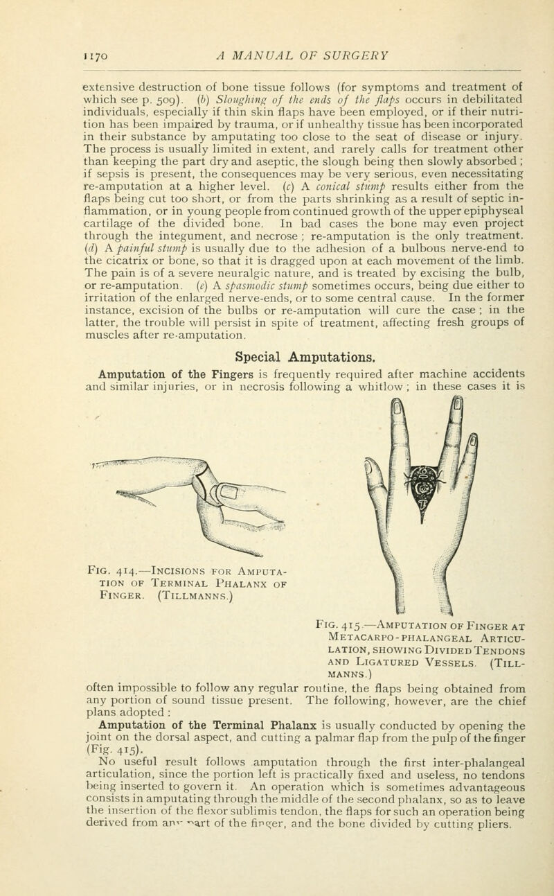 extensive destruction of bone tissue follows (for symptoms and treatment of which see p. 509). (b) Sloughing of the ends of the flaps occurs in debilitated individuals, especially if thin skin flaps have been employed, or if their nutri- tion has been impaired by trauma, or if unhealthy tissue has been incorporated in their substance by amputating too close to the seat of disease or injury. The process is usually limited in extent, and rarely calls for treatment other than keeping the part dry and aseptic, the slough being then slowly absorbed ; if sepsis is present, the consequences may be very serious, even necessitating re-amputation at a higher level, (c) A conical stump results either from the flaps being cut too short, or from the parts shrinking as a result of septic in- flammation , or in young people from continued growth of the upper epiphyseal cartilage of the divided bone. In bad cases the bone may even project through the integument, and necrose ; re-amputation is the only treatment. (d) A painful stump is usually due to the adhesion of a bulbous nerve-end to the cicatrix or bone, so that it is dragged upon at each movement of the limb. The pain is of a severe neuralgic nature, and is treated by excising the bulb, or re-amputation, (e) A spasmodic stump sometimes occurs, being due either to irritation of the enlarged nerve-ends, or to some central cause. In the former instance, excision of the bulbs or re-amputation will cure the case ; in the latter, the trouble will persist in spite of treatment, affecting fresh groups of muscles after re-amputation. Special Amputations. Amputation of the Fingers is frequently required after machine accidents and similar injuries, or in necrosis following a whitlow ; in these cases it is Fig. 414.—Incisions for Amputa- tion of Terminal Phalanx of Finger. (Tillmanns.) Fig. 415.—Amputation of Finger at metacarpophalangeal articu- LATION, showing Divided Tendons and Ligatured Vessels. (Till- manns.) often impossible to follow any regular routine, the flaps being obtained from any portion of sound tissue present. The following, however, are the chief plans adopted : Amputation of the Terminal Phalanx is usually conducted by opening the joint on the dorsal aspect, and cutting a palmar flap from the pulp of the finger (Fig. 415). No useful result follows amputation through the first inter-phalangeal articulation, since the portion left is practically fixed and useless, no tendons being inserted to govern it. An operation which is sometimes advantageous consists in amputating through the middle of the second phalanx, so as to leave the insertion of the flexor sublimis tendon, the flaps for such an operation being derived from am- ^art of the finger, and the bone divided by cutting pliers.