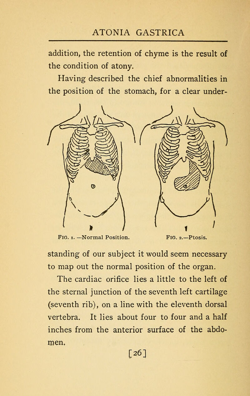 addition, the retention of chyme is the result of the condition of atony. Having described the chief abnormalities in the position of the stomach, for a clear under- *i'^ Fig. I. —Normal Position. Fig. 2.—Ptosis. Standing of our subject it would seem necessary to map out the normal position of the organ. The cardiac orifice lies a little to the left of the sternal junction of the seventh left cartilage (seventh rib), on a line with the eleventh dorsal vertebra. It lies about four to four and a half inches from the anterior surface of the abdo- men, [26]