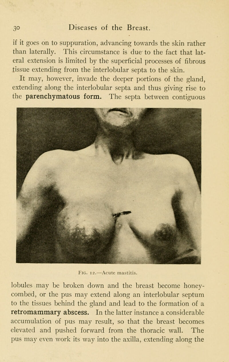 if it goes on to suppuration, advancing towards the skin rather than laterally. This circumstance is due to the fact that lat- eral extension is limited by the superficial processes of fibrous tissue extending from the interlobular septa to the skin. It may, however, invade the deeper portions of the gland, extending along the interlobular septa and thus giving rise to the parenchymatous form. The septa between contiguous Fig. 12.—Acute mastitis. lobules may be broken down and the breast become honey- combed, or the pus may extend along an interlobular septum to the tissues behind the gland and lead to the formation of a retromammary abscess. In the latter instance a considerable accumulation of pus may result, so that the breast becomes elevated and pushed forward from the thoracic wall. The pus may even work its way into the axilla, extending along the