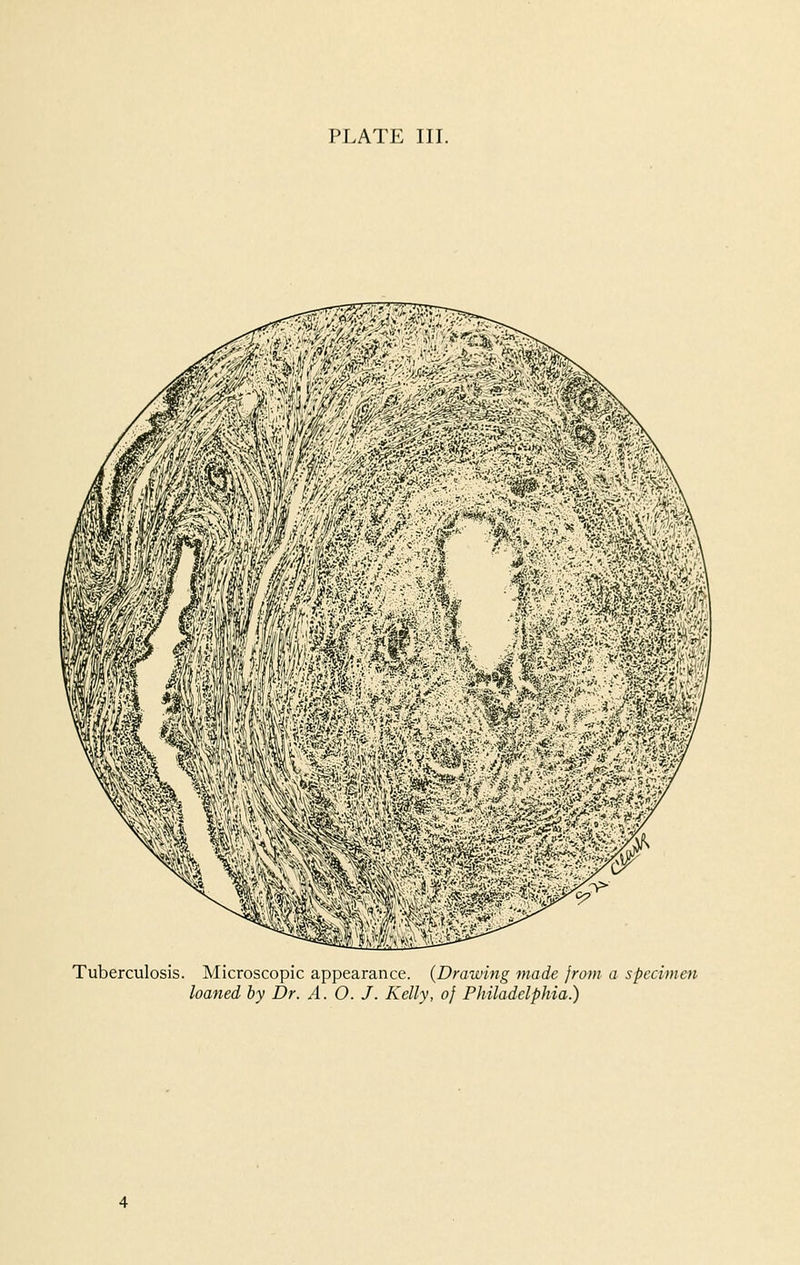 PLATE III. Tuberculosis. Microscopic appearance. (Drawing made from a specimen loaned by Dr. A. O. J. Kelly, of Philadelphia.)