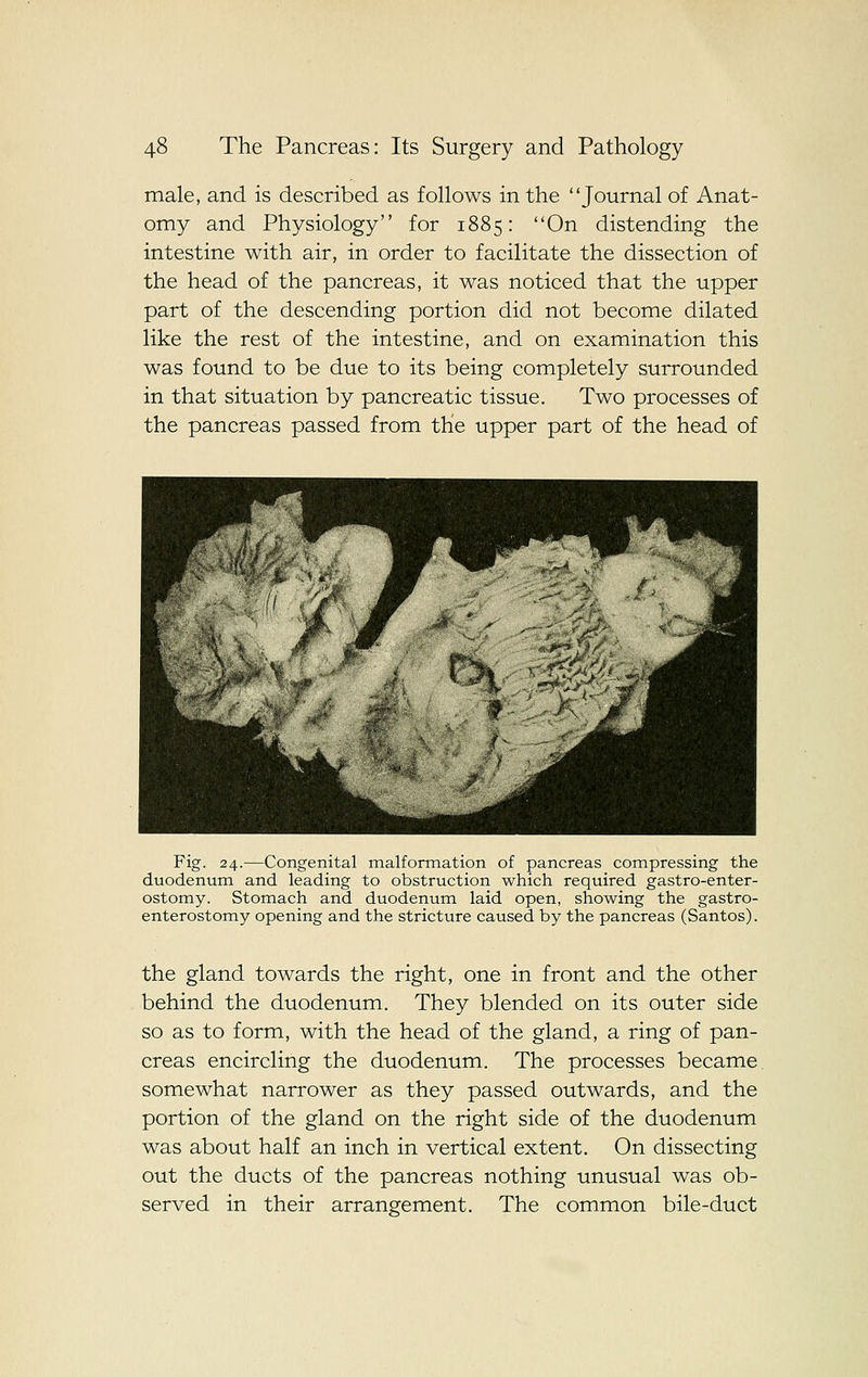 male, and is described as follows in the Journal of Anat- omy and Physiology for 1885: On distending the intestine with air, in order to facilitate the dissection of the head of the pancreas, it was noticed that the upper part of the descending portion did not become dilated like the rest of the intestine, and on examination this was found to be due to its being completely surrounded in that situation by pancreatic tissue. Two processes of the pancreas passed from the upper part of the head of Fig. 24.—Congenital malformation of pancreas compressing the duodenum and leading to obstruction which required gastro-enter- ostomy. Stomach and duodenum laid open, showing the gastro- enterostomy opening and the stricture caused by the pancreas (Santos). the gland towards the right, one in front and the other behind the duodenum. They blended on its outer side so as to form, with the head of the gland, a ring of pan- creas encircling the duodenum. The processes became somewhat narrower as they passed outwards, and the portion of the gland on the right side of the duodenum was about half an inch in vertical extent. On dissecting out the ducts of the pancreas nothing unusual was ob- served in their arrangement. The common bile-duct