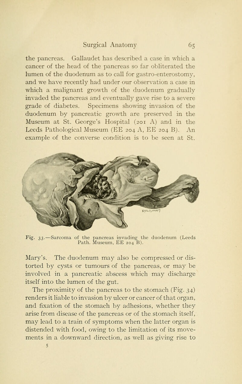 the pancreas. Gallaudet has described a case in which a cancer of the head of the pancreas so far obHterated the lumen of the duodenum as to call for gastro-enterostomy, and we have recently had under our observation a case in which a malignant growth of the duodenum gradually invaded the pancreas and eventually gave rise to a severe grade of diabetes. Specimens showing invasion of the duodenum by pancreatic growth are preserved in the Museum at St. George's Hospital (201 A) and in the Leeds Pathological Museum (EE 204 A, EE 204 B). An example of the converse condition is to be seen at St. Fig- 33-—Sarcoma of the pancreas invading the duodenum (Leeds Path. Museum, EE 204 B). Mary's. The duodenum may also be compressed or dis- torted by cysts or tumours of the pancreas, or may be involved in a pancreatic abscess which may discharge itself into the lumen of the gut. The proximity of the pancreas to the stomach (Fig. 34) renders it liable to invasion by ulcer or cancer of that organ, and fixation of the stomach by adhesions, whether they arise from disease of the pancreas or of the stomach itself, may lead to a train of symptoms when the latter organ is distended with food, owing to the limitation of its move- ments in a downward direction, as well as giving rise to 5