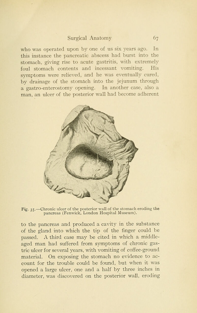 who was operated upon by one of us six years ago. In this instance the pancreatic abscess had burst into the stomach, giving rise to acute gastritis, with extremely foul stomach contents and incessant vomiting. His symptoms were relieved, and he was eventually cured, by drainage of the stomach into the jejunum through a gastro-enterostomy opening. In another case, also a man, an ulcer of the posterior wall had become adherent Fig. 35.—Chronic ulcer of the posterior wall of the stomach eroding the pancreas (Fenwick, London Hospital Museum). to the pancreas and produced a cavity in the substance of the gland into which the tip of the finger could be passed. A third case may be cited in which a middle- aged man had suffered from symptoms of chronic gas- tric ulcer for several years, with vomiting of coffee-ground material. On exposing the stomach no evidence to ac- count for the trouble could be found, but when it was opened a large ulcer, one and a half by three inches in diameter, was discovered on the posterior wall, eroding