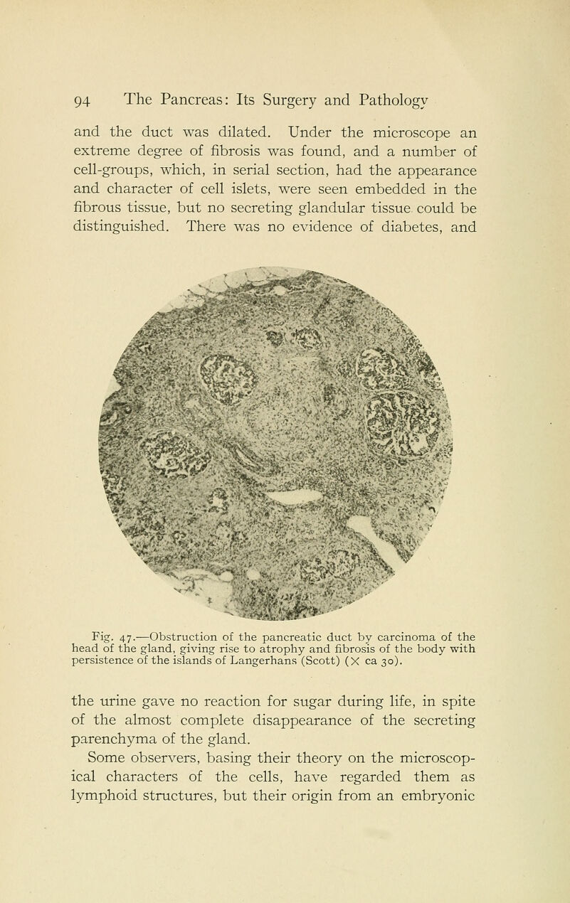 and the duct was dilated. Under the microscope an extreme degree of fibrosis was found, and a number of cell-groups, which, in serial section, had the appearance and character of cell islets, were seen embedded in the fibrous tissue, but no secreting glandular tissue could be distinguished. There was no evidence of diabetes, and * ^l^ Fig. 47.—Obstruction of the pancreatic duct by carcinoma of the head of the gland, giving rise to atrophy and fibrosis of the body with persistence of the islands of Langerhans (Scott) (X ca 30). the urine gave no reaction for sugar during life, in spite of the almost complete disappearance of the secreting parenchyma of the gland. Some observers, basing their theory on the microscop- ical characters of the cells, have regarded them as lymphoid structures, but their origin from an embryonic