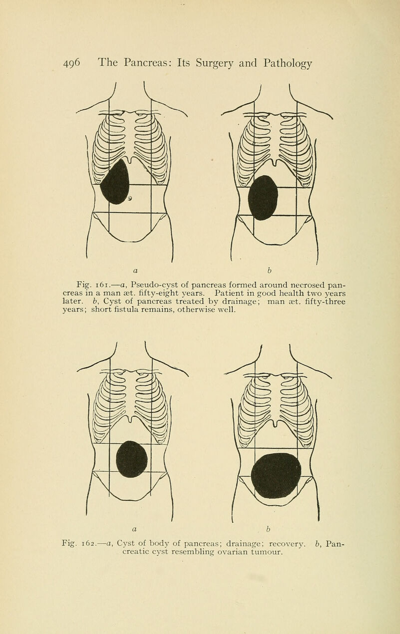 Fig. 161.—a, Pseudo-cyst of pancreas formed around necrosed pan- creas in a man ast. fifty-eight years. Patient in good health two years later, b, Cyst of pancreas treated by drainage; man set. fifty-three years; short fistula remains, otherwise well. Fig. 162.—a, Cyst of body of pancreas; drainage; recovery, b, Pan- creatic cyst resembling ovarian tumour.