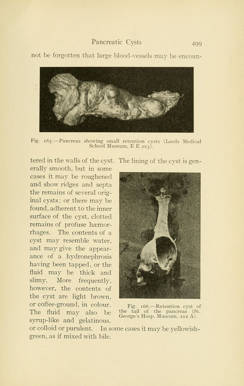 not be forgotten that large blood-vessels may be encoun- Fig. 165.—Pancreas showing small retention cysts (Leeds Medical School Museum, E E 203). tered in the walls of the cyst. The lining of the cyst is gen- erally smooth, but in some cases it may be roughened and show ridges and septa the remains of several orig- inal cysts; or there may be found, adherent to the inner surface of the cyst, clotted remains of profuse hasmor- rhages. The contents of a cyst may resemble water, and may give the appear- ance of a hydronephrosis having been tapped, or the fluid may be thick and slimy. More frequently, however, the contents of the cyst are light brown, or coffee-ground, in colour. The fluid may also be syrup-like and gelatinous, or colloid or purulent. In some cases it may be yellowish- green, as if mixed with bile. Fig. 166.—Retention cyst of the tail of the pancreas (St. George's Hosp. Museum, 202 A).