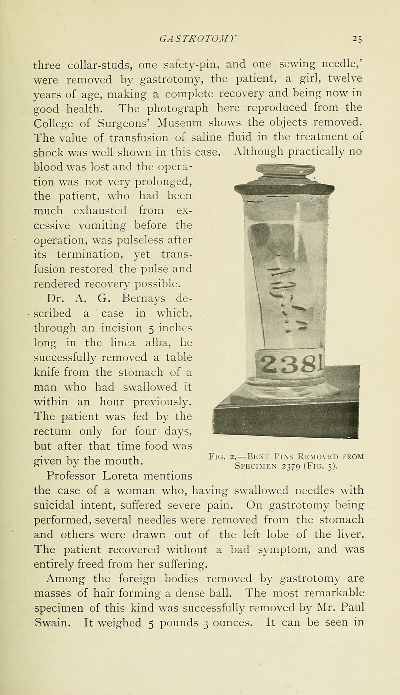 three collar-studs, one safety-pin, and one sewing needle,' were removed by gastrotomy, the patient, a girl, twelve years of age, making a complete recovery and being now in good health. The photograph here reproduced from the College of Surgeons' Museum shows the objects removed. The value of transfusion of saline fluid in the treatment of shock was well shown in this case. Although practically no blood was lost and the opera- tion was not very prolonged, the patient, who had been much exhausted from ex- cessive vomiting before the operation, was pulseless after its termination, yet trans- fusion restored the pulse and rendered recovery possible. Dr. A. G. Bernays de- scribed a case in which, through an incision 5 inches long in the linea alba, he successfully removed a table knife from the stomach of a man who had swallowed it within an hour previousl3\ The patient was fed by the rectum only for four days, but after that time food was given by the mouth. Professor Loreta mentions the case of a woman who, having swallowed needles with suicidal intent, suffered severe pain. On gastrotomy being performed, several needles were removed from the stomach and others were drawn out of the left lobe of the liver. The patient recovered without a bad symptom, and was entirely freed from her suffering. Among the foreign bodies removed by gastrotomy are masses of hair forming a dense ball. The most remarkable specimen of this kind was successfully removed by Mr. Paul Swain. It weighed 5 pounds 3 ounces. It can be Seen in Fig. 2.—Bent Pins Removed from Specimen 2379 (Fig. 5).