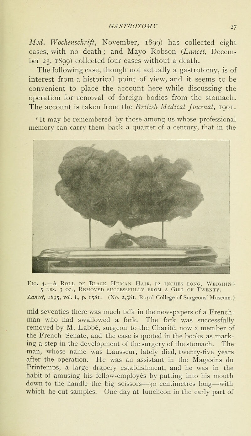 Med. WochenscJmft, November, 1899) has collected eight cases, with no death; and Mayo Robson {Lancet, Decem- ber 23, 1899) collected four cases without a death. The following case, though not actually a gastrotomy, is of interest from a historical point of view, and it seems to be convenient to place the account here while discussing the operation for removal of foreign bodies from the stomach. The account is taken from the British Medical Journal, 1901. ' It may be remembered by those among us whose professional memory can carry them back a quarter of a century, that in the Fig. 4.—A Roll of Black Human Hair, 12 inches long. Weighing 5 LBS. 3 oz , Removed successfully from a Girl of Twenty. Lancet, 1895, vol. i., p. 1581. (No. 2,381, Royal College of Surgeons'Museum.) mid seventies there was much talk in the newspapers of a French- man who had swallowed a fork. The fork was successfully removed by M. Labbe, surgeon to the Charite, now a member of the French Senate, and the case is quoted in the books as mark- ing a step in the development of the surgery of the stomach. The man, whose name was Lausseur, lately died, twenty-five years after the operation. He was an assistant in the Magasins du Printemps, a large drapery establishment, and he was in the habit of amusing his fellow-employes by putting into his mouth down to the handle the big scissors—30 centimetres long—with which he cut samples. One day at luncheon in the early part of